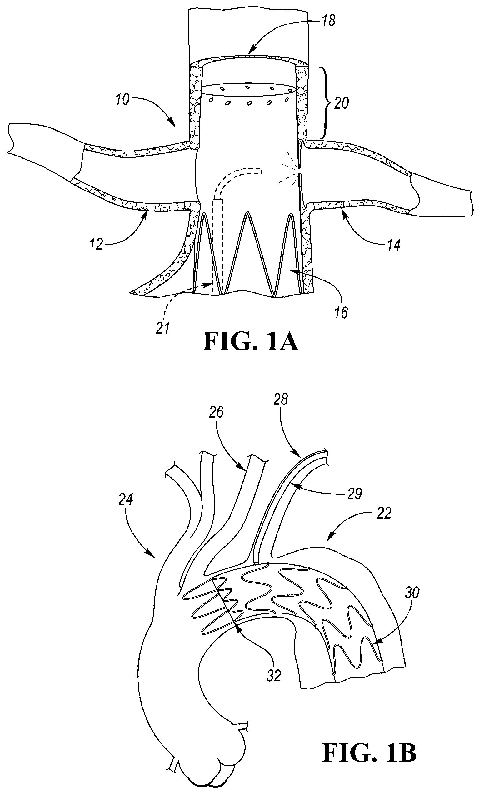 Patent US12426910 Figure 1 – In-situ fenestration devices with ultrasonic cutter