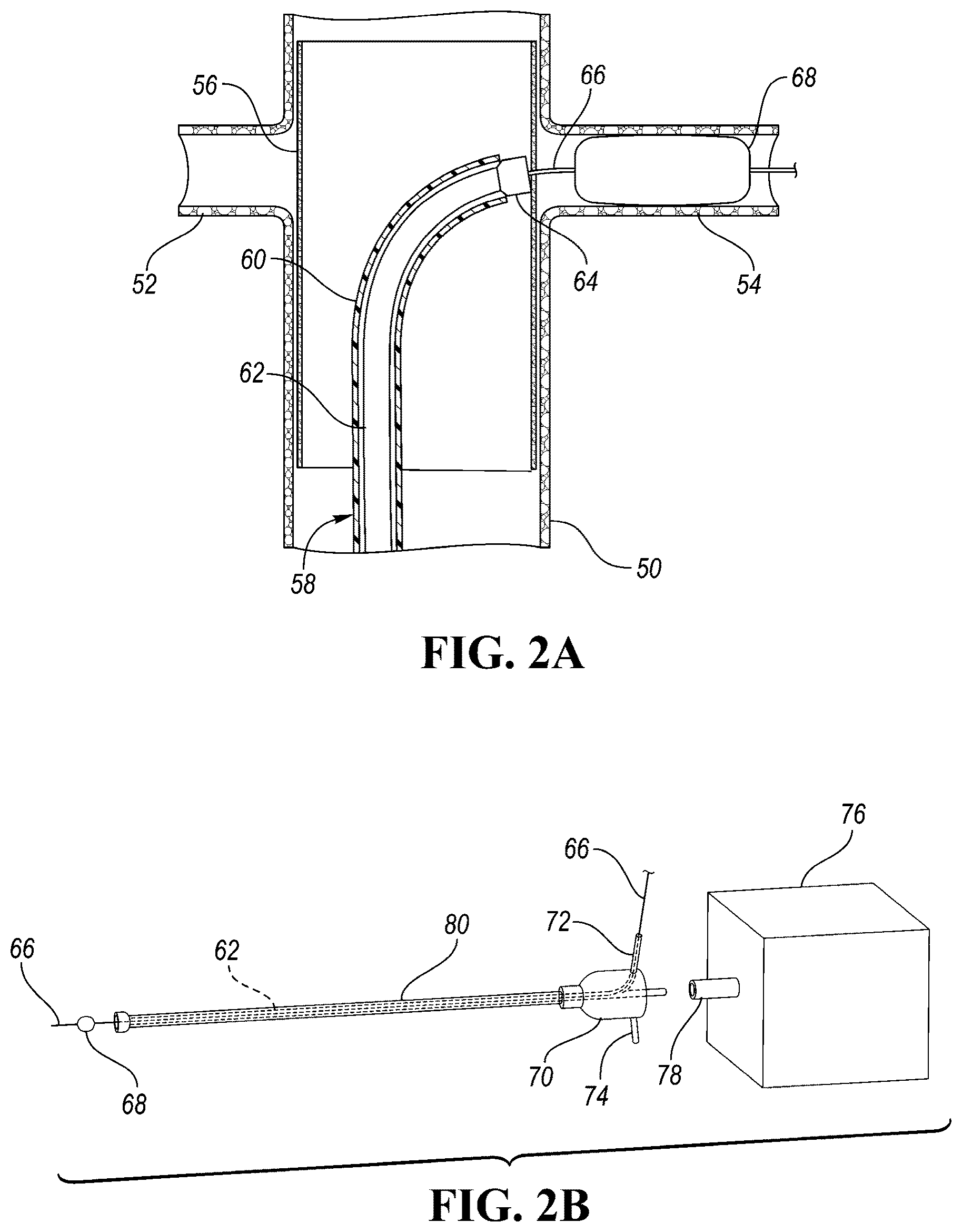 Patent US12426910 Figure 2 – In-situ fenestration devices with ultrasonic cutter