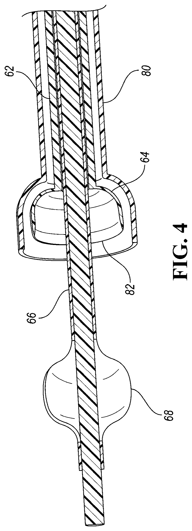 Patent US12426910 Figure 4 – In-situ fenestration devices with ultrasonic cutter