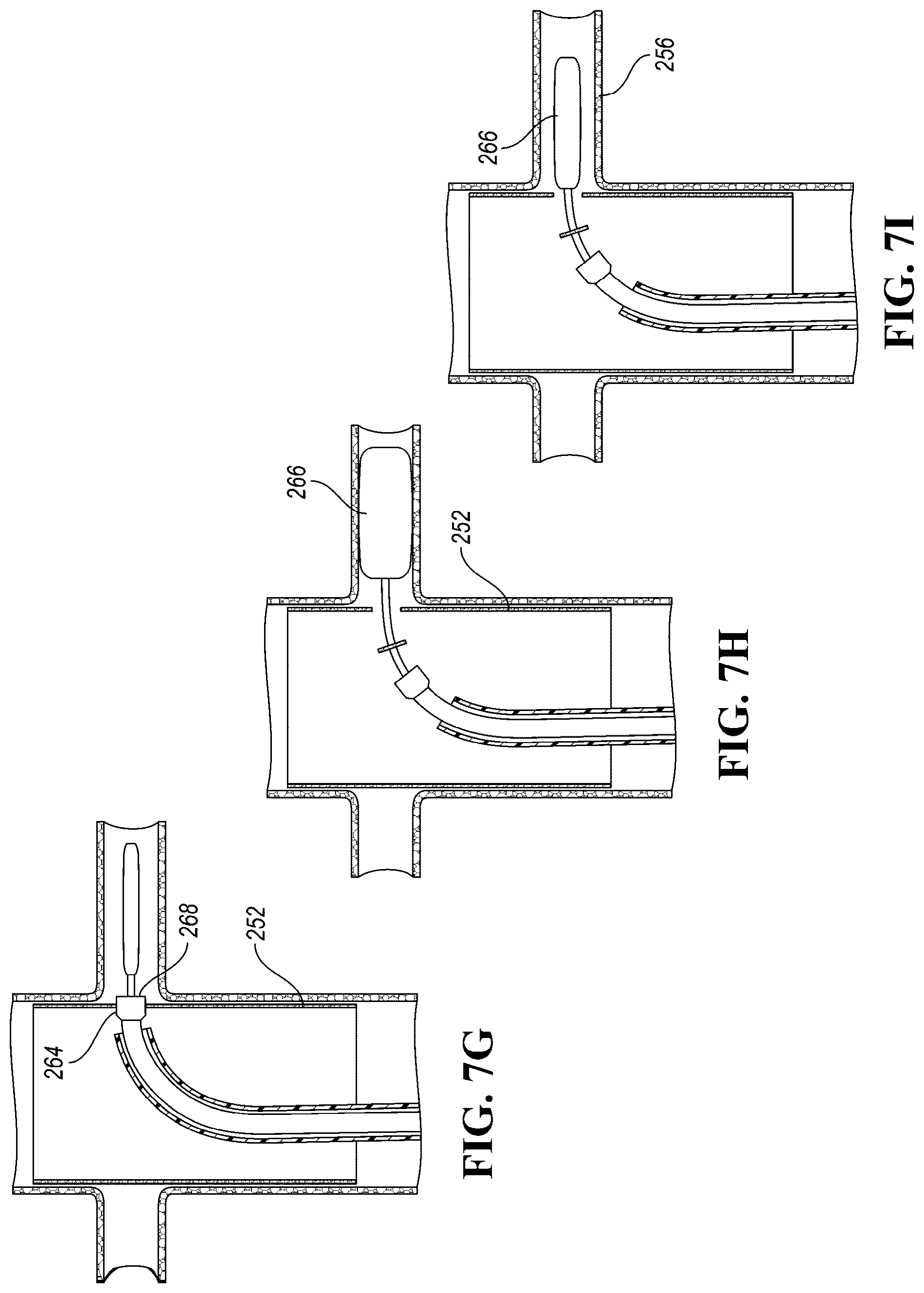 Patent US12426910 Figure 11 – In-situ fenestration devices with ultrasonic cutter