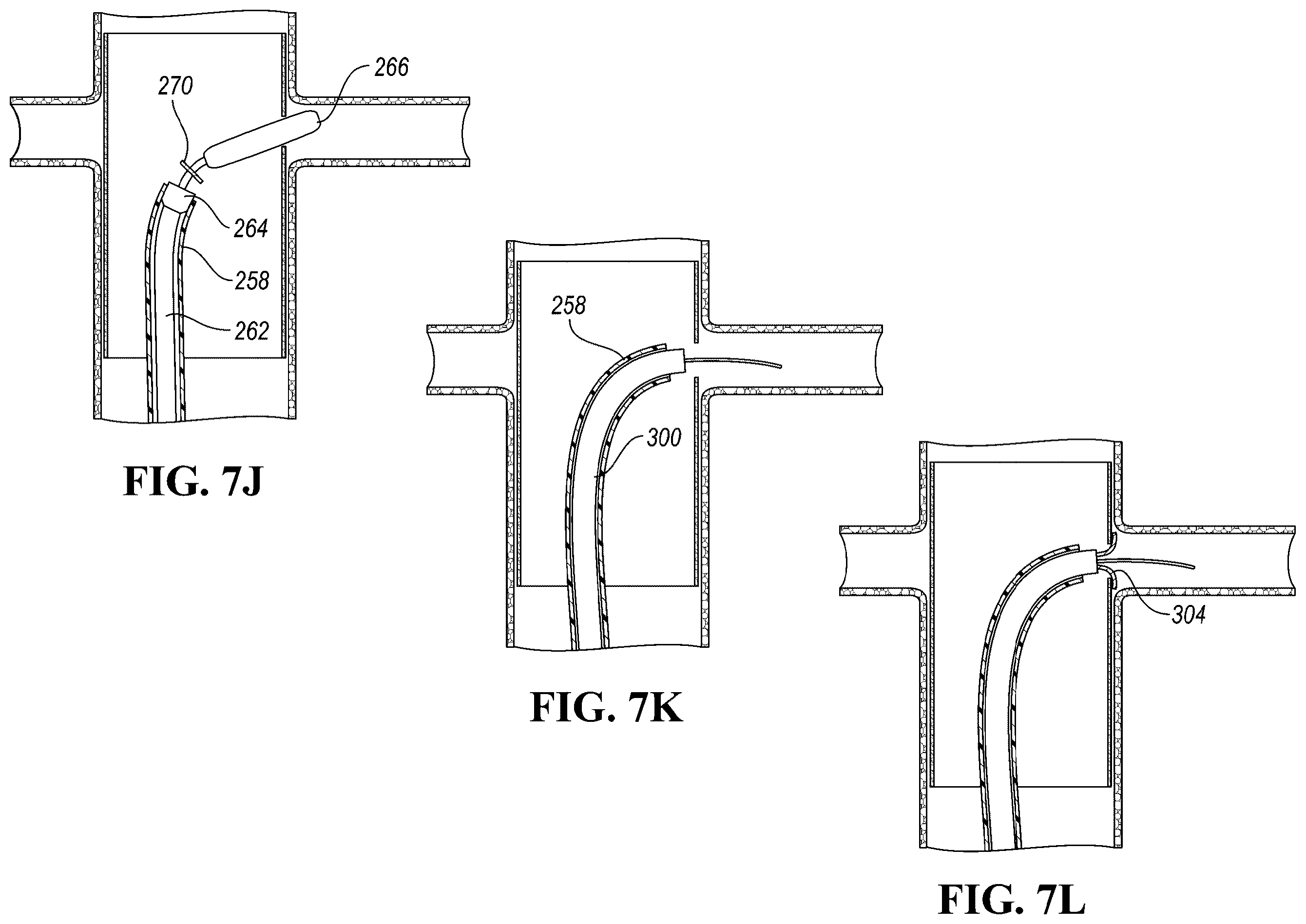 Patent US12426910 Figure 12 – In-situ fenestration devices with ultrasonic cutter