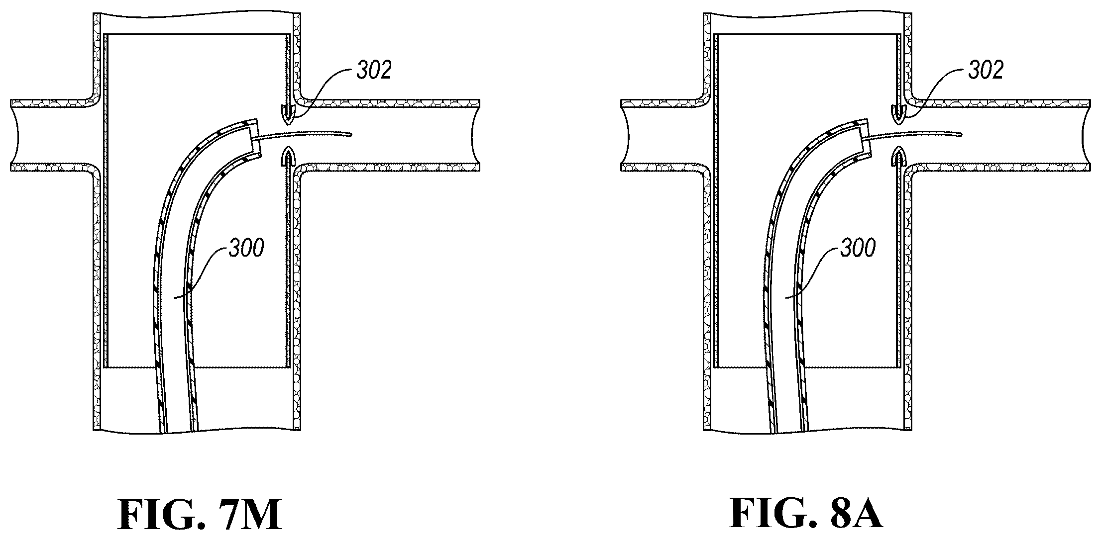 Patent US12426910 Figure 13 – In-situ fenestration devices with ultrasonic cutter