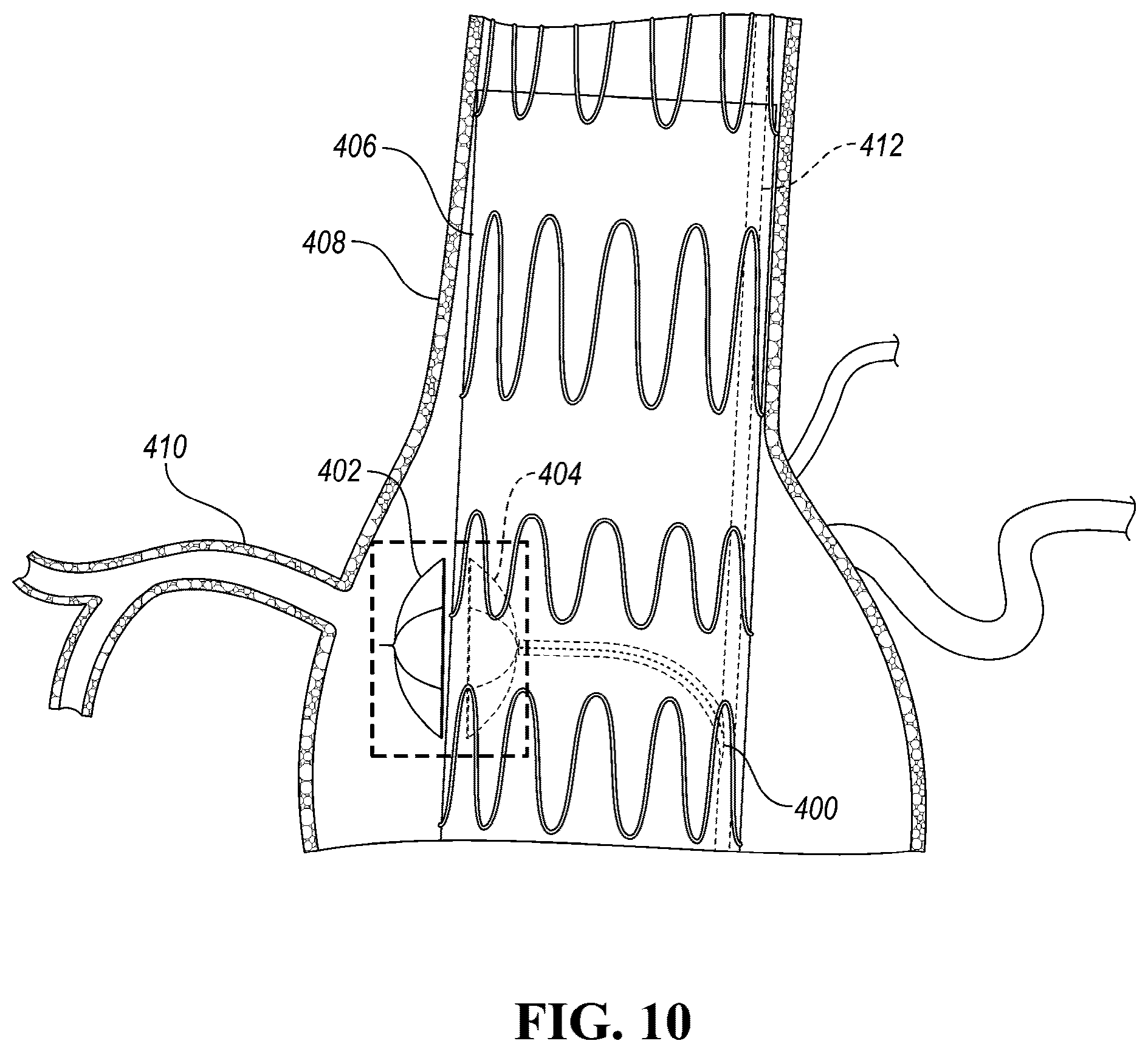 Patent US12426910 Figure 16 – In-situ fenestration devices with ultrasonic cutter