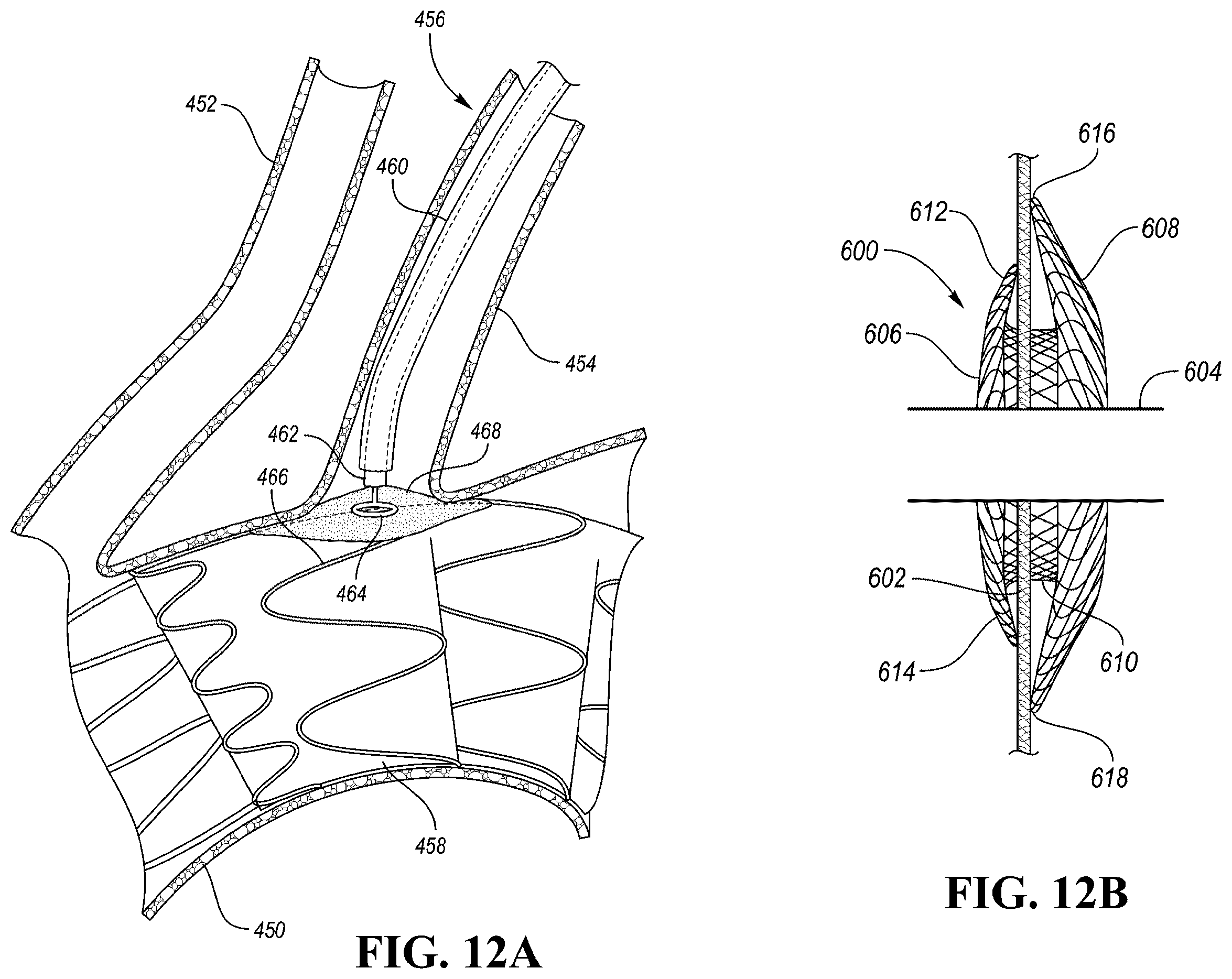 Patent US12426910 Figure 18 – In-situ fenestration devices with ultrasonic cutter
