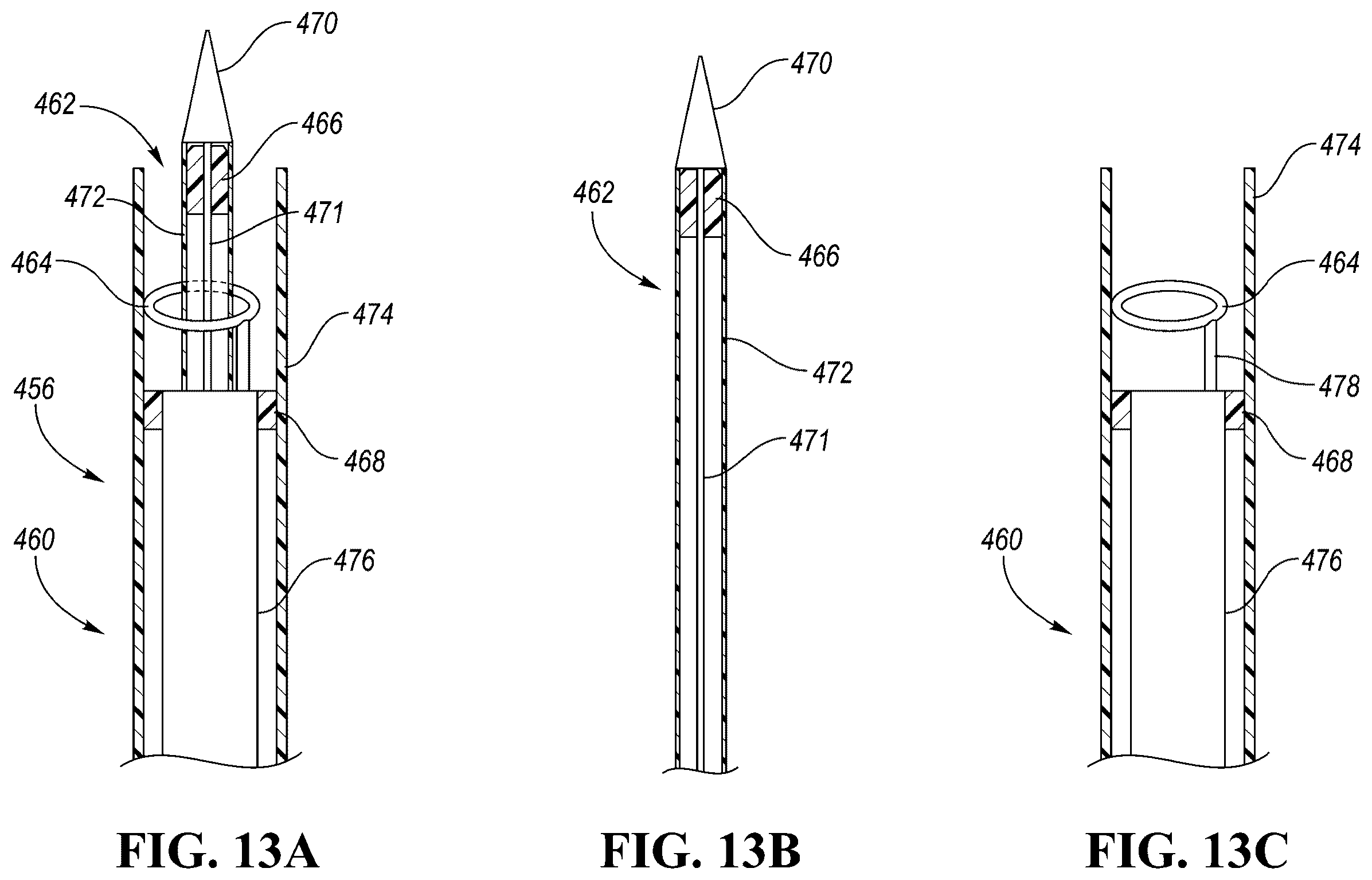 Patent US12426910 Figure 19 – In-situ fenestration devices with ultrasonic cutter