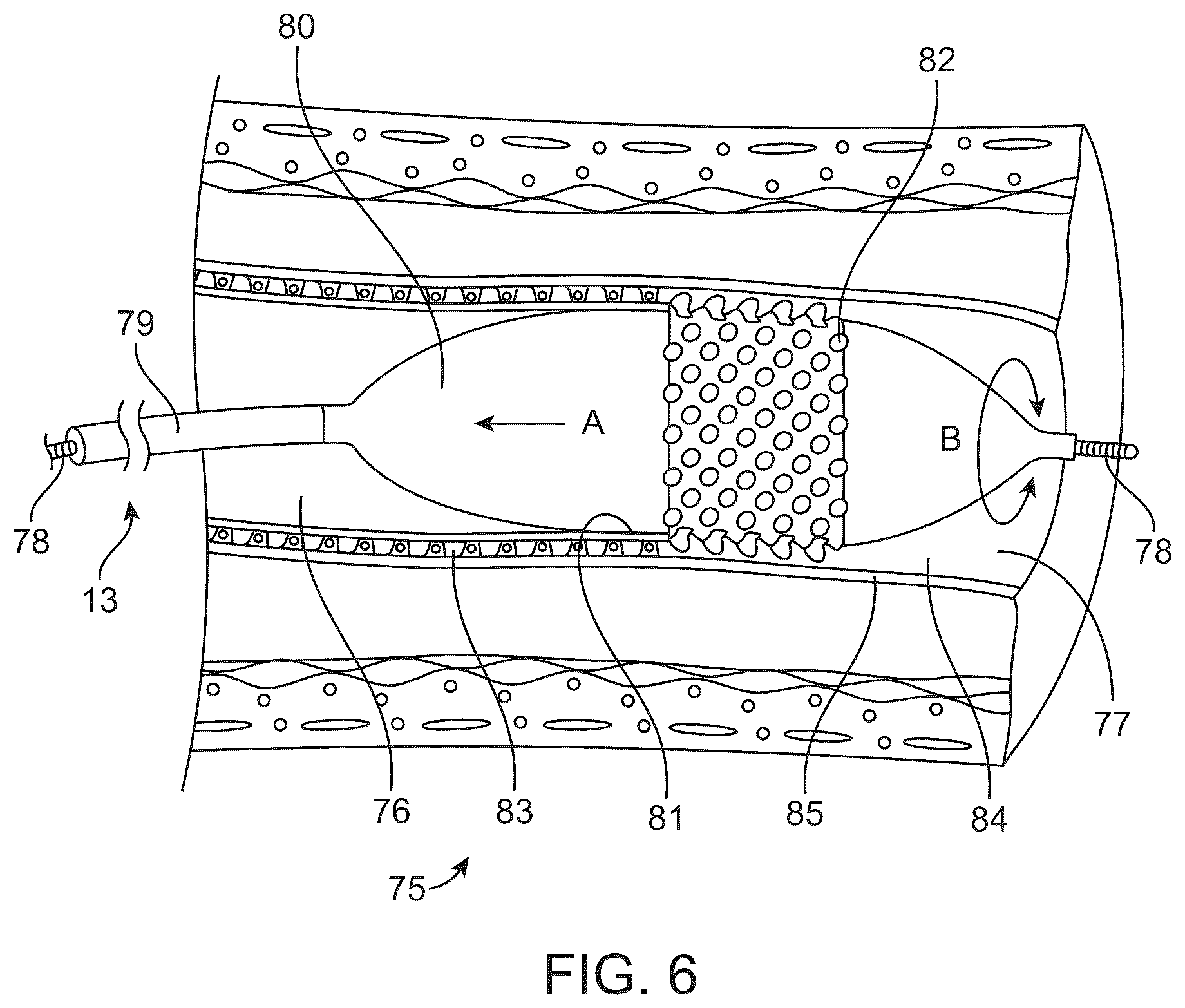 Patent US12426916 Figure 5 – Devices, methods, and systems to treat chronic bronchitis