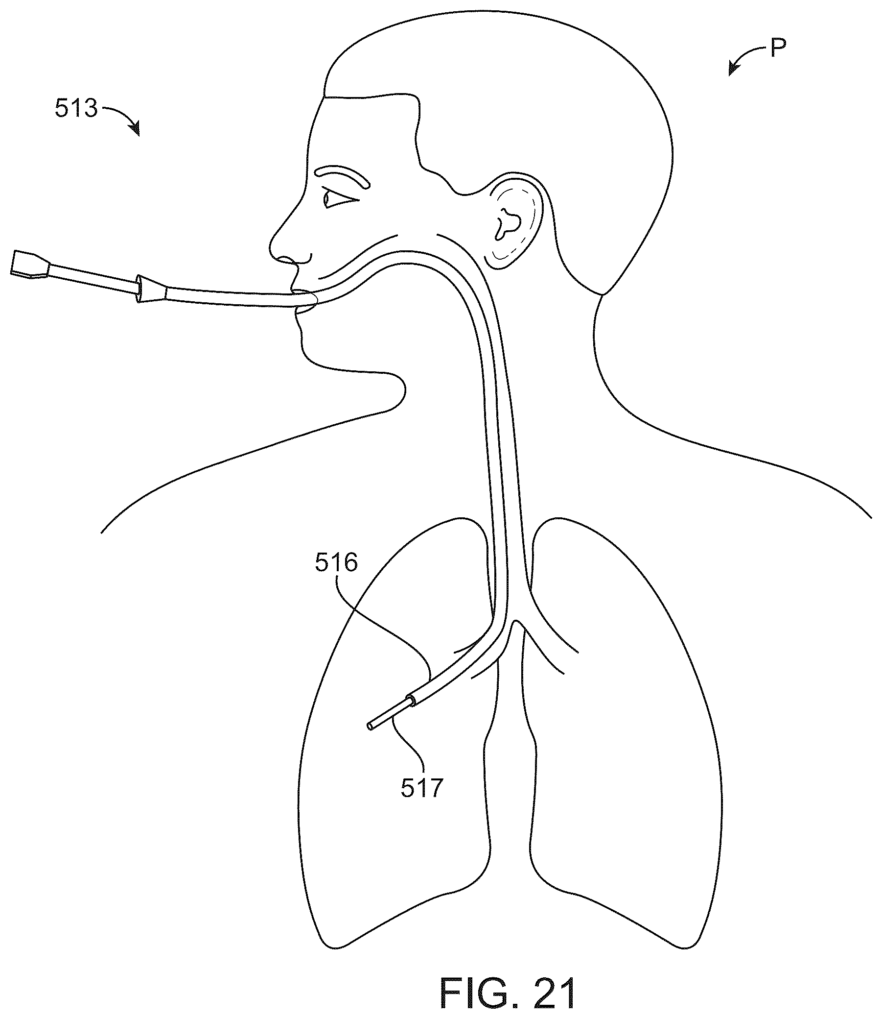 Patent US12426916 Figure 17 – Devices, methods, and systems to treat chronic bronchitis