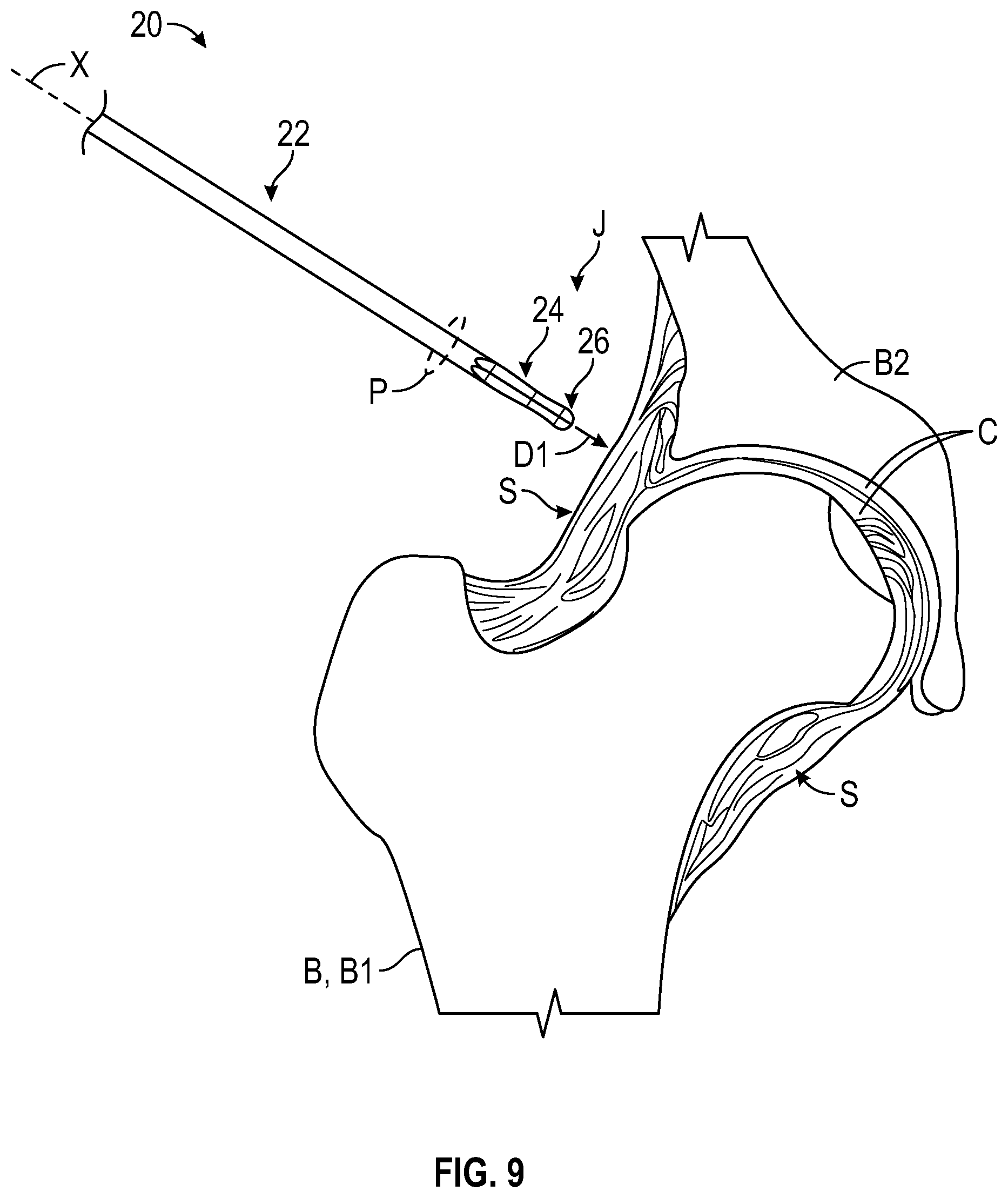 Patent US12426918 Figure 6 – Atraumatic instruments and associated methods for capsulotomy