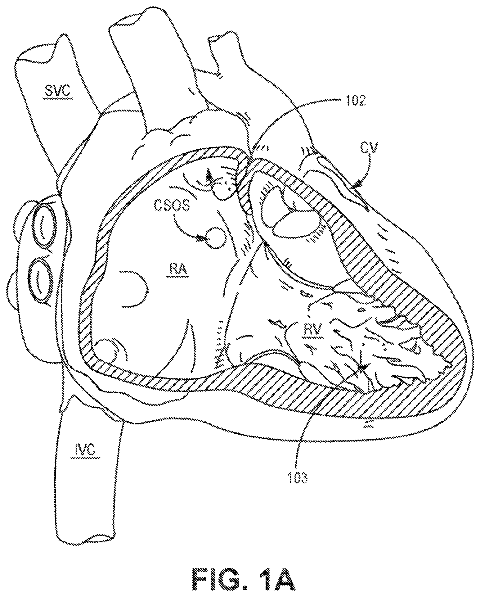 Patent US12426921 Figure 1 – Interventional medical systems and associated assemblies