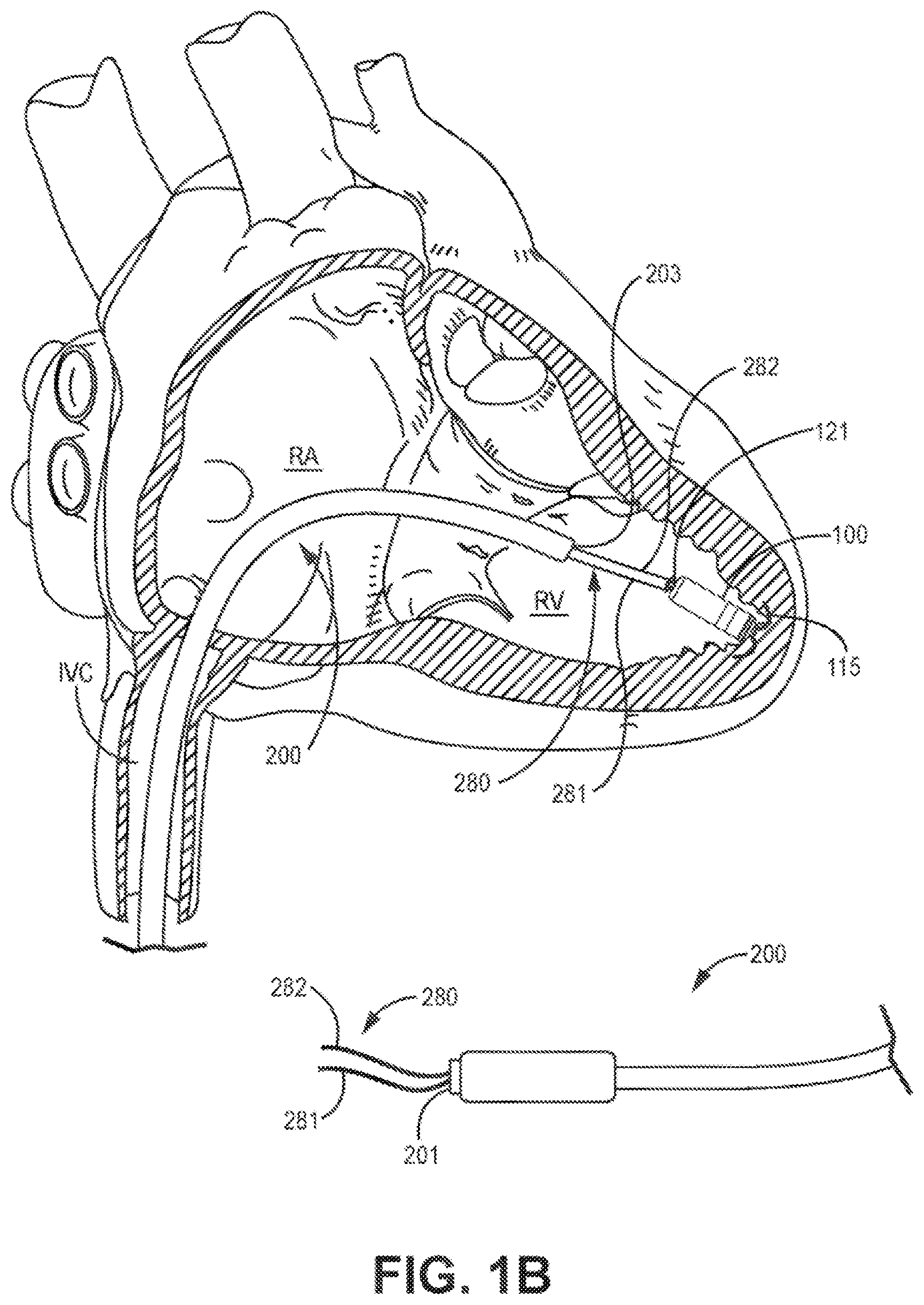 Patent US12426921 Figure 2 – Interventional medical systems and associated assemblies
