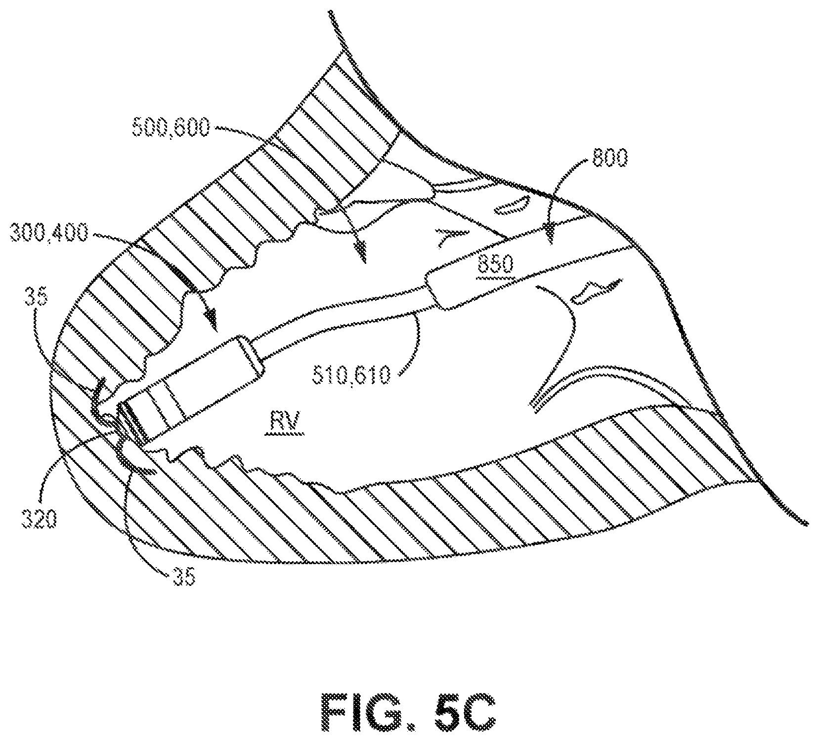 Patent US12426921 Figure 17 – Interventional medical systems and associated assemblies