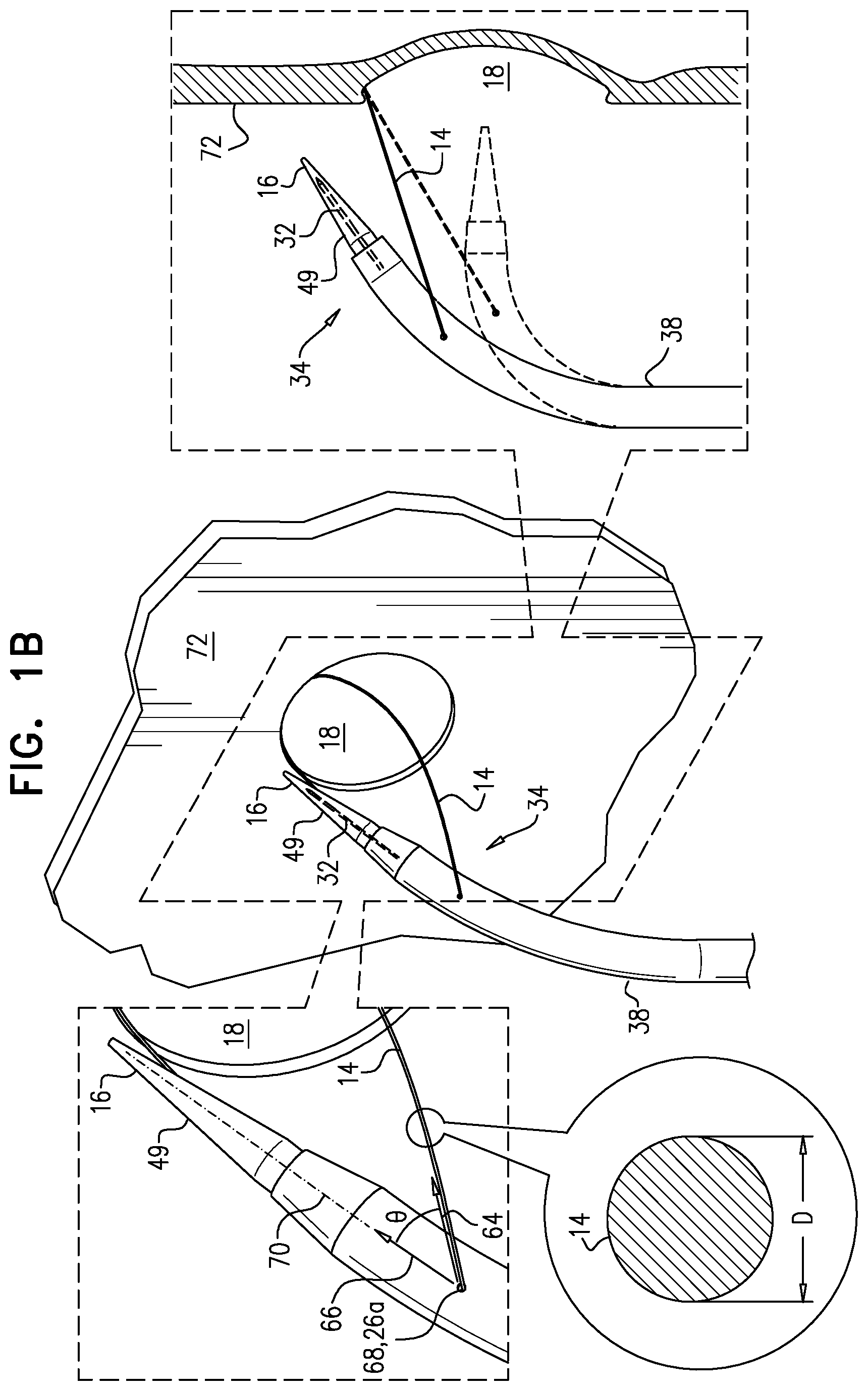Patent US12426922 Figure 2 – Fossa ovalis penetration catheter
