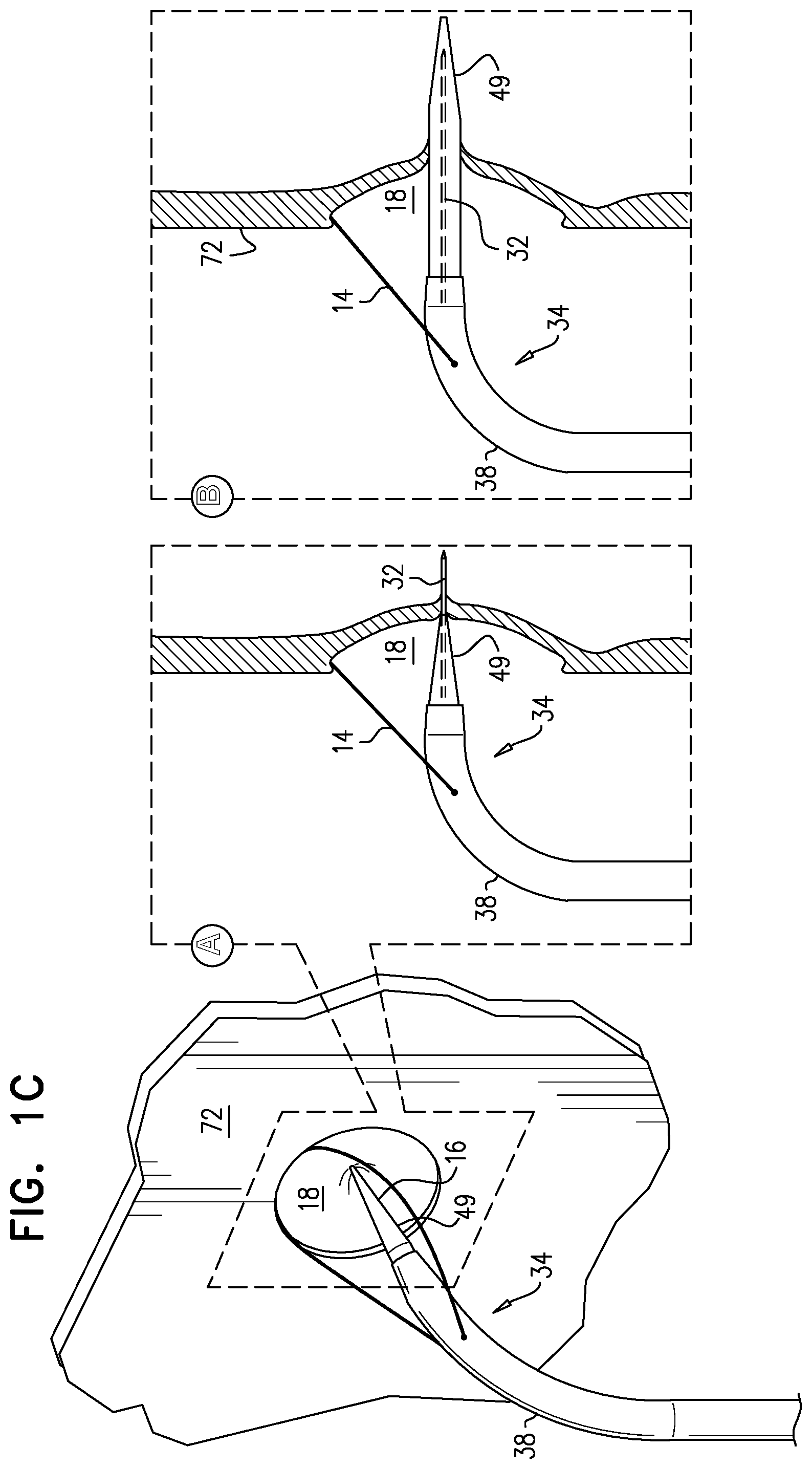 Patent US12426922 Figure 3 – Fossa ovalis penetration catheter