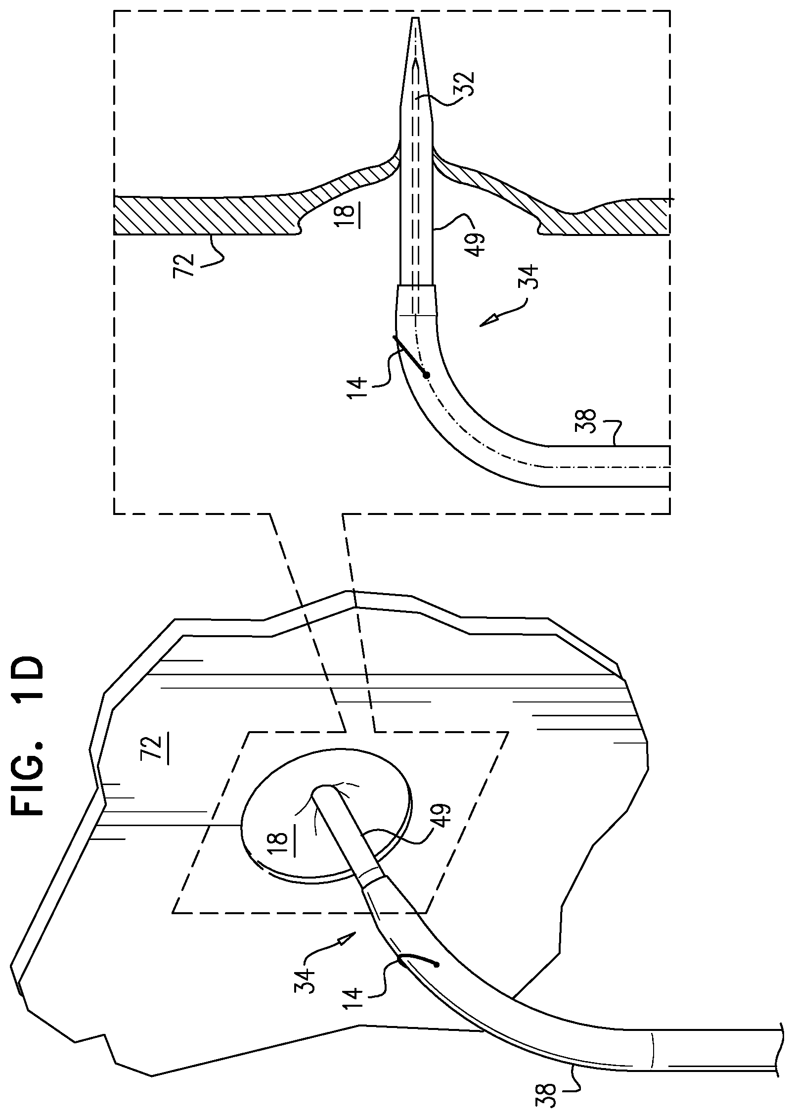 Patent US12426922 Figure 4 – Fossa ovalis penetration catheter