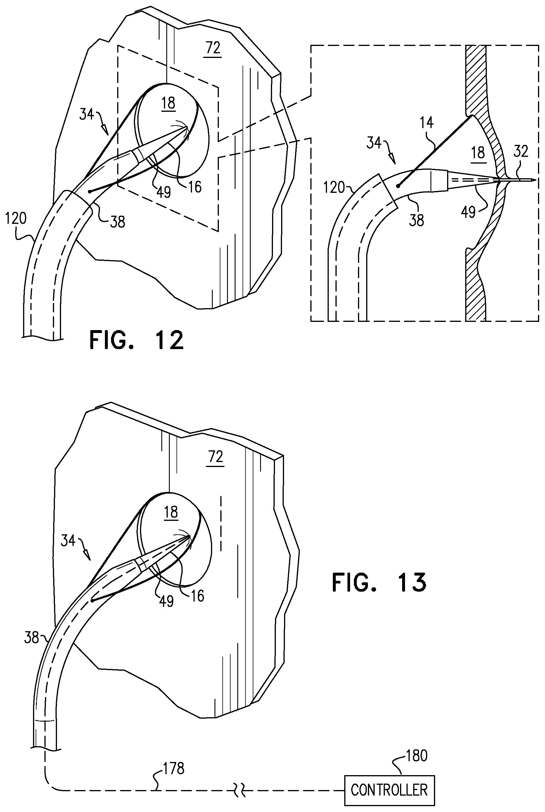 Patent US12426922 Figure 11 – Fossa ovalis penetration catheter