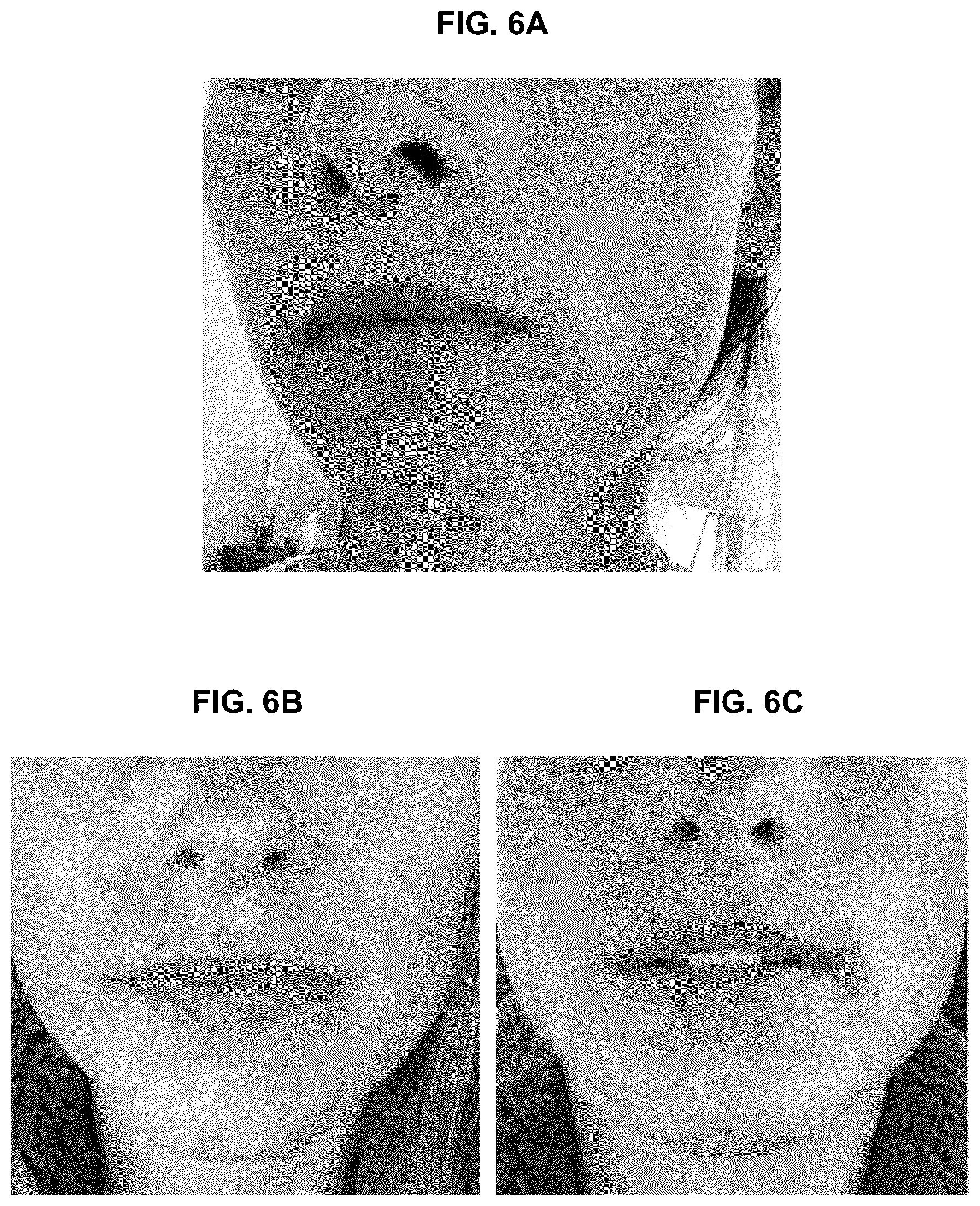 Patent US12426924 Figure 17 – Device and method for treating dermatitis, psoriasis, acne and other disorders of the skin