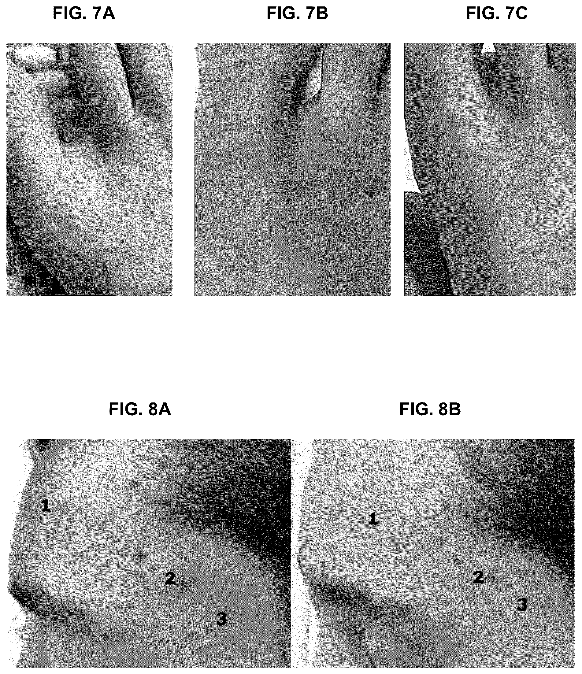 Patent US12426924 Figure 18 – Device and method for treating dermatitis, psoriasis, acne and other disorders of the skin
