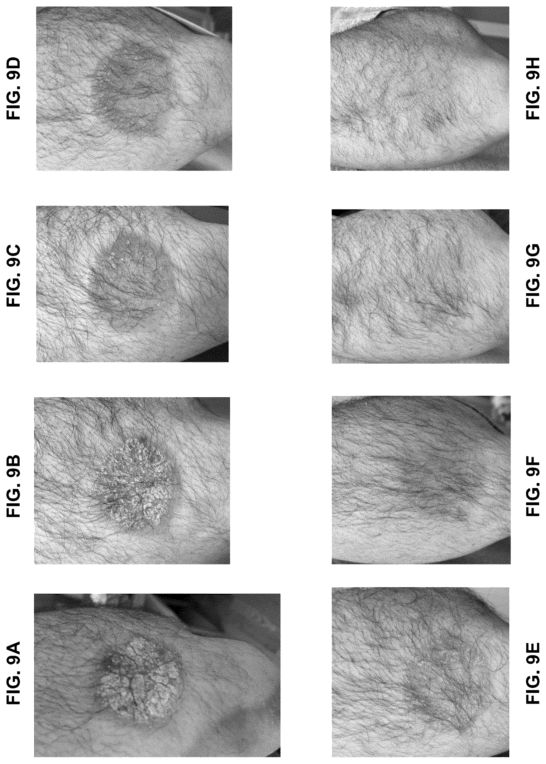 Patent US12426924 Figure 19 – Device and method for treating dermatitis, psoriasis, acne and other disorders of the skin