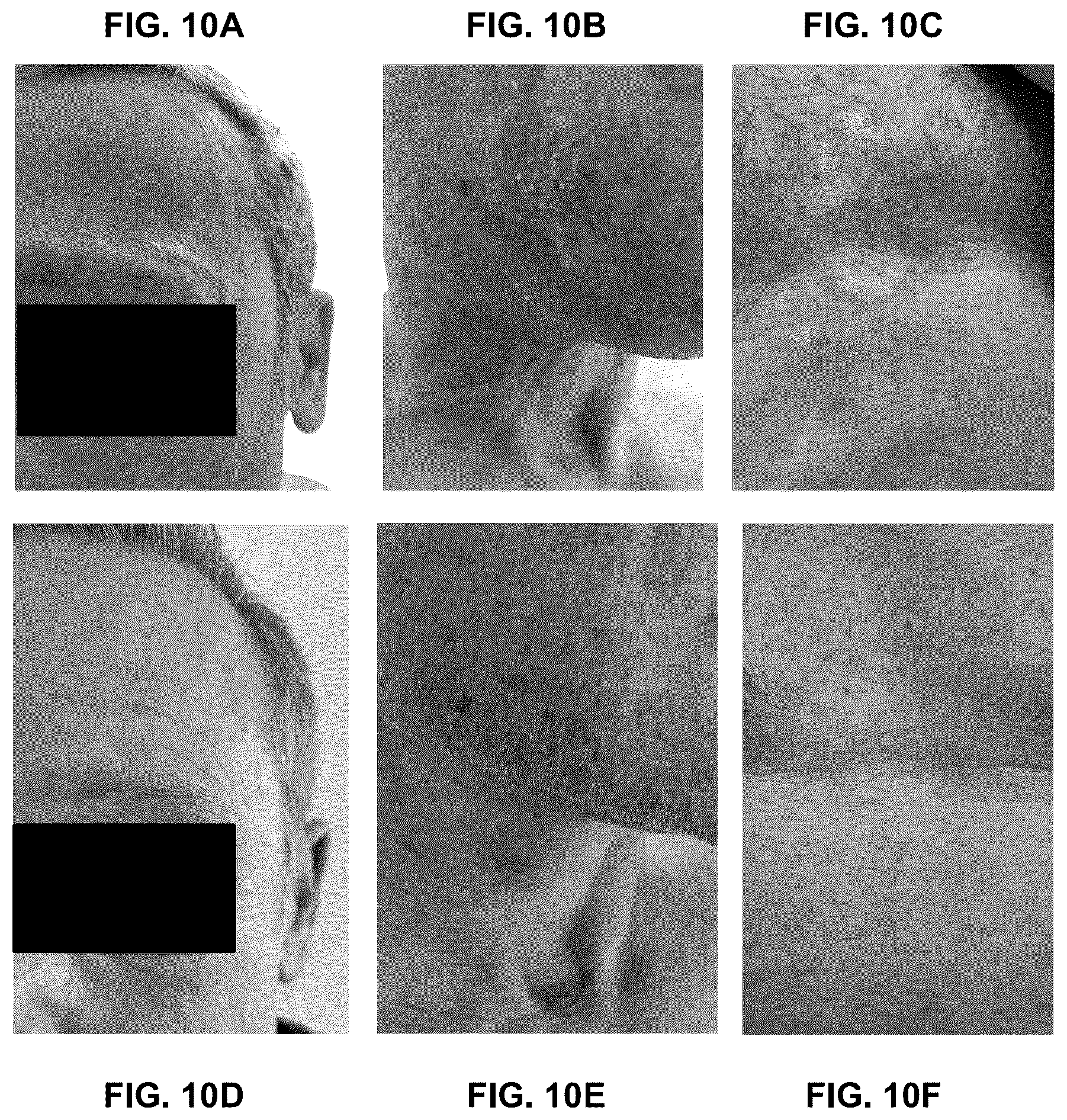 Patent US12426924 Figure 20 – Device and method for treating dermatitis, psoriasis, acne and other disorders of the skin
