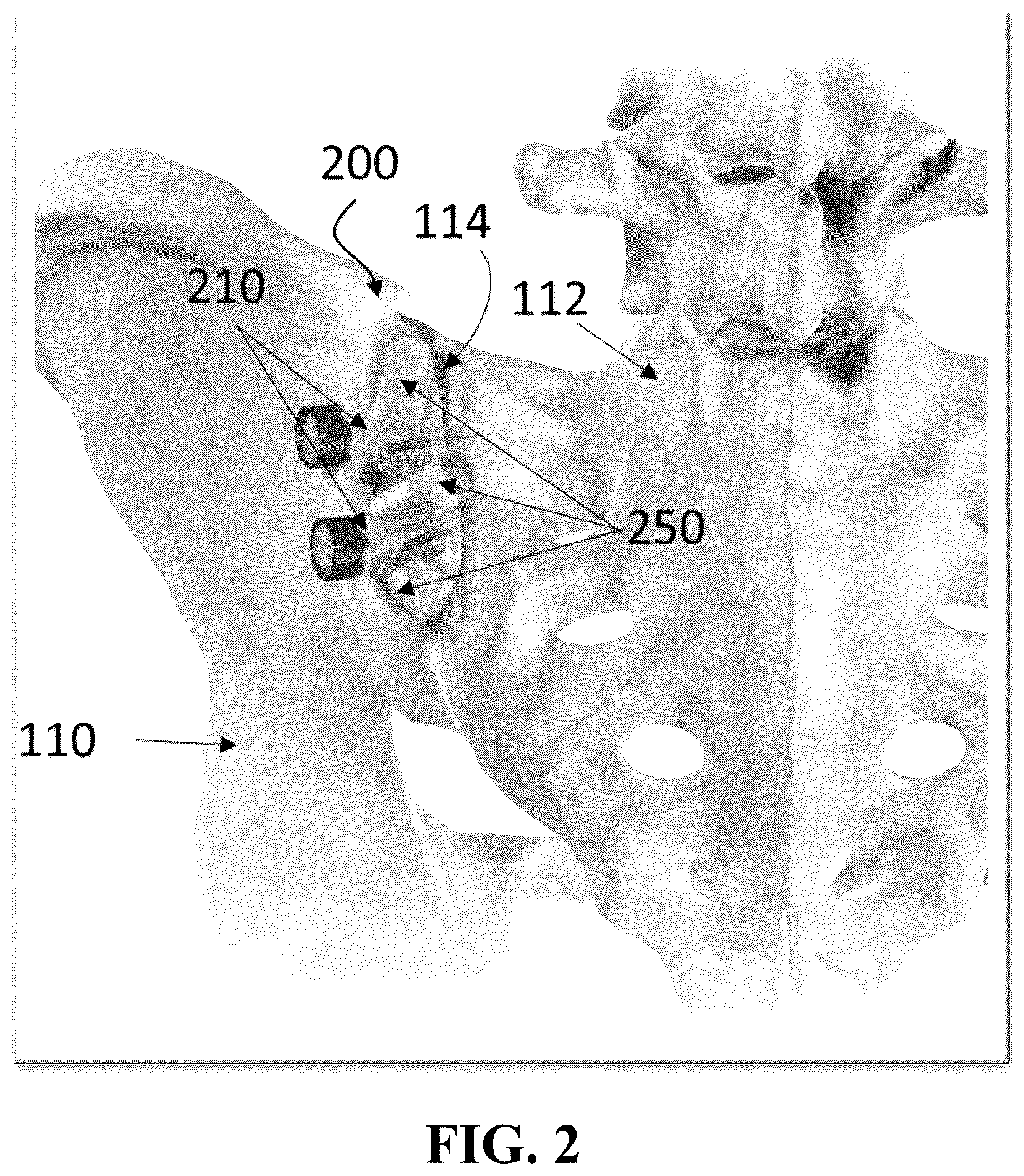 Patent US12426926 Figure 2 – Hybrid approach methods for sacroiliac joint stabilization