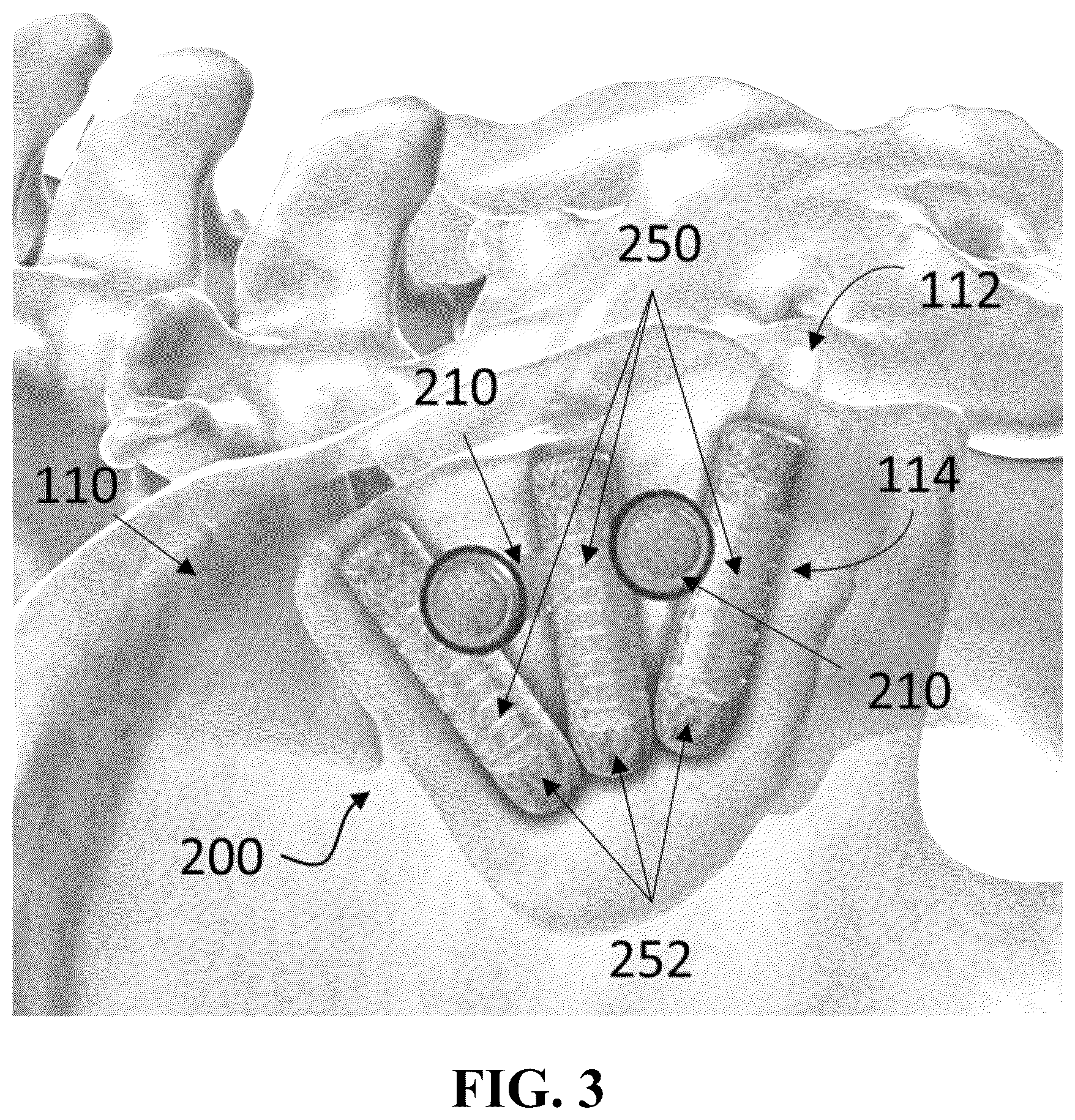 Patent US12426926 Figure 3 – Hybrid approach methods for sacroiliac joint stabilization
