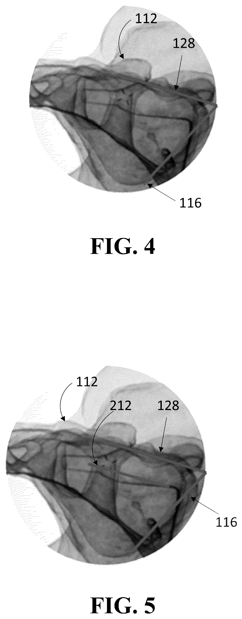 Patent US12426926 Figure 4 – Hybrid approach methods for sacroiliac joint stabilization