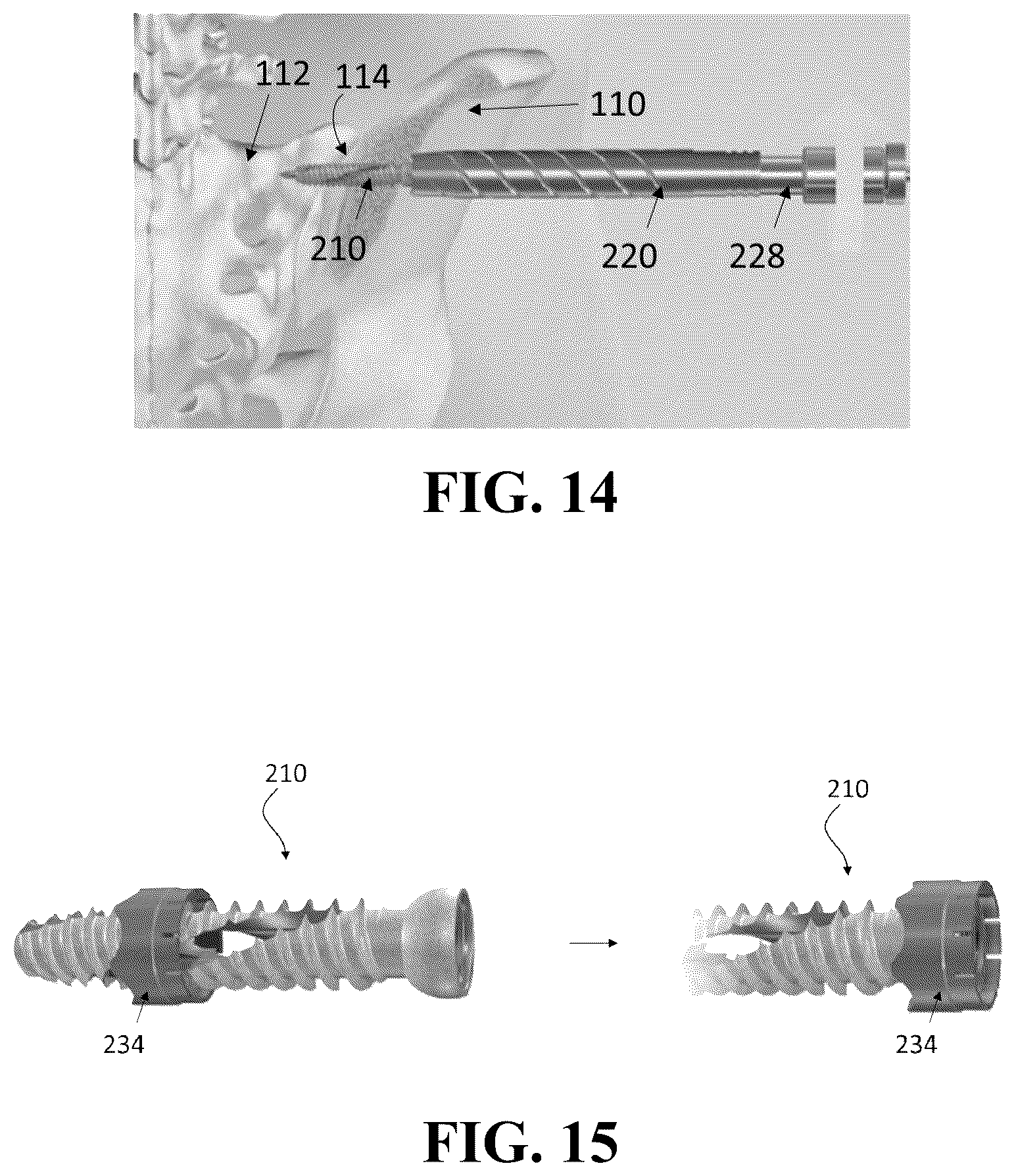 Patent US12426926 Figure 9 – Hybrid approach methods for sacroiliac joint stabilization