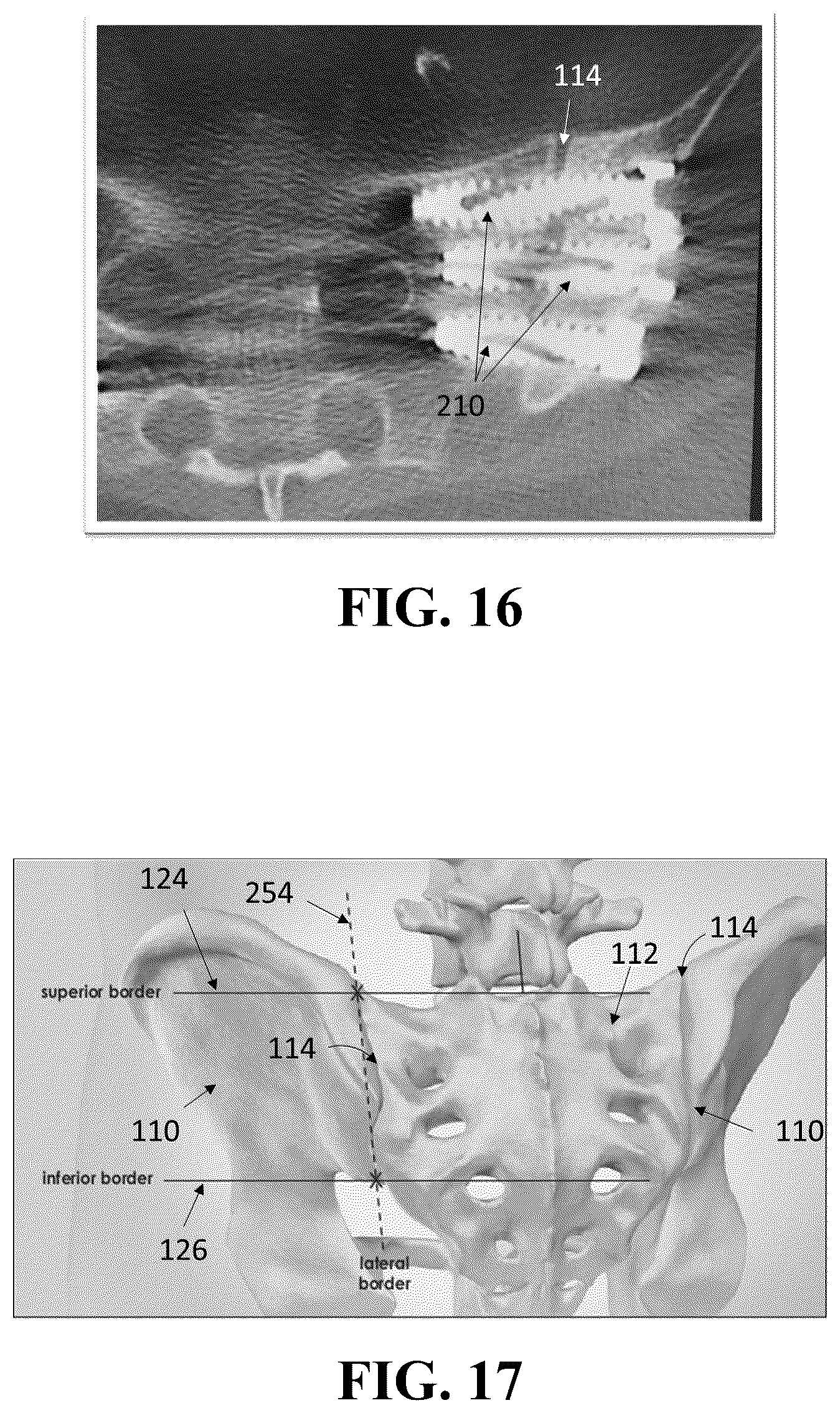 Patent US12426926 Figure 10 – Hybrid approach methods for sacroiliac joint stabilization