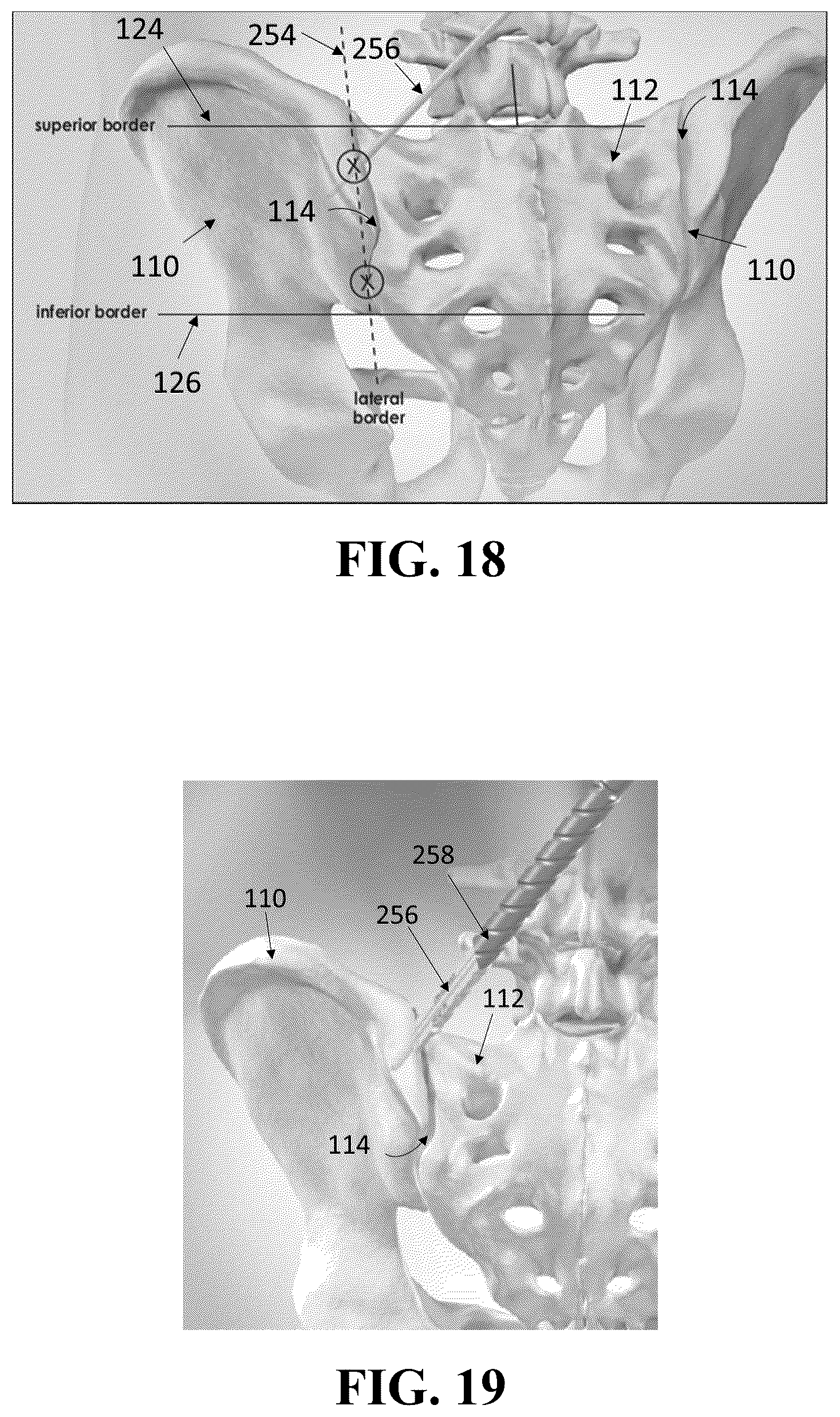 Patent US12426926 Figure 11 – Hybrid approach methods for sacroiliac joint stabilization