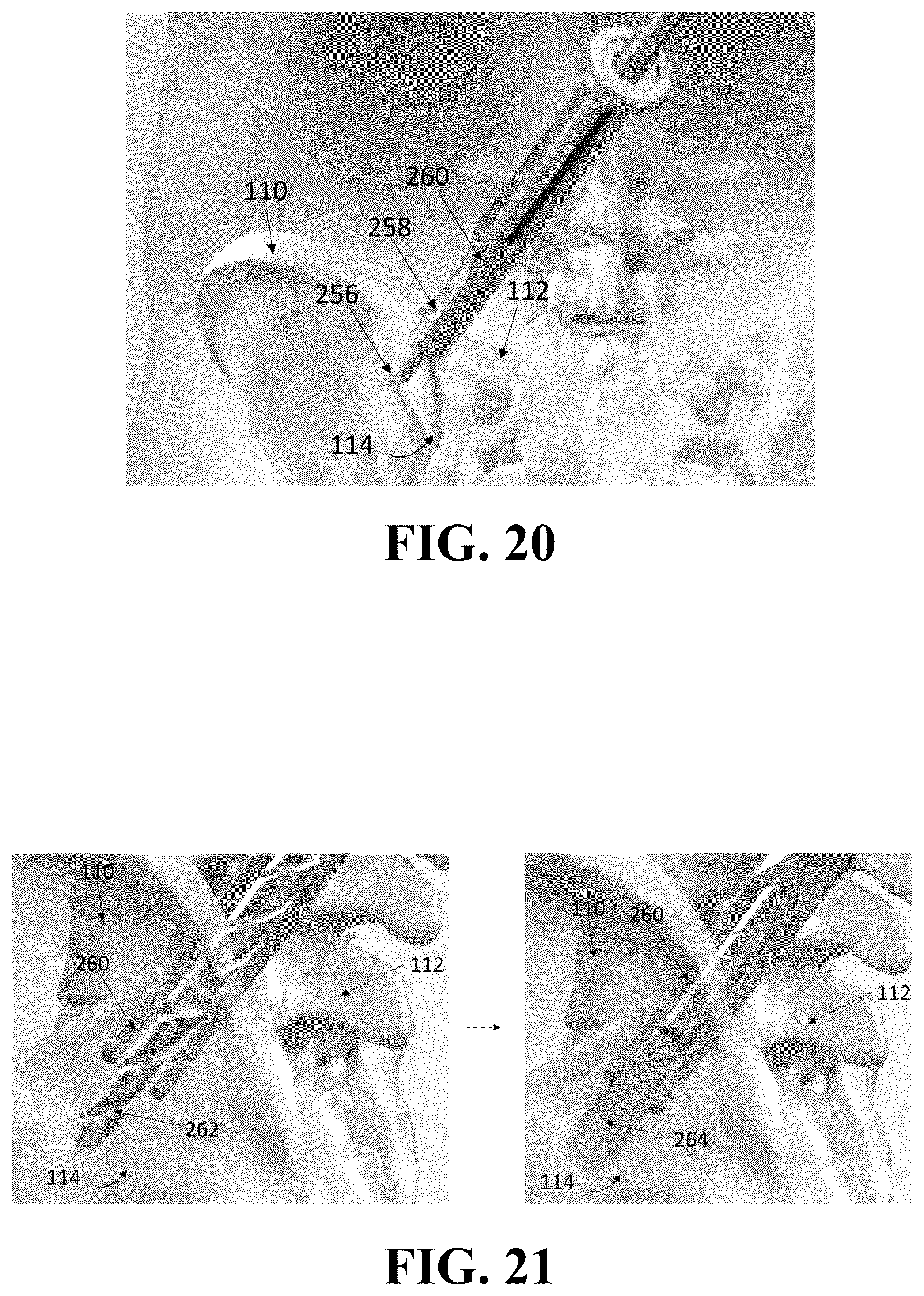 Patent US12426926 Figure 12 – Hybrid approach methods for sacroiliac joint stabilization