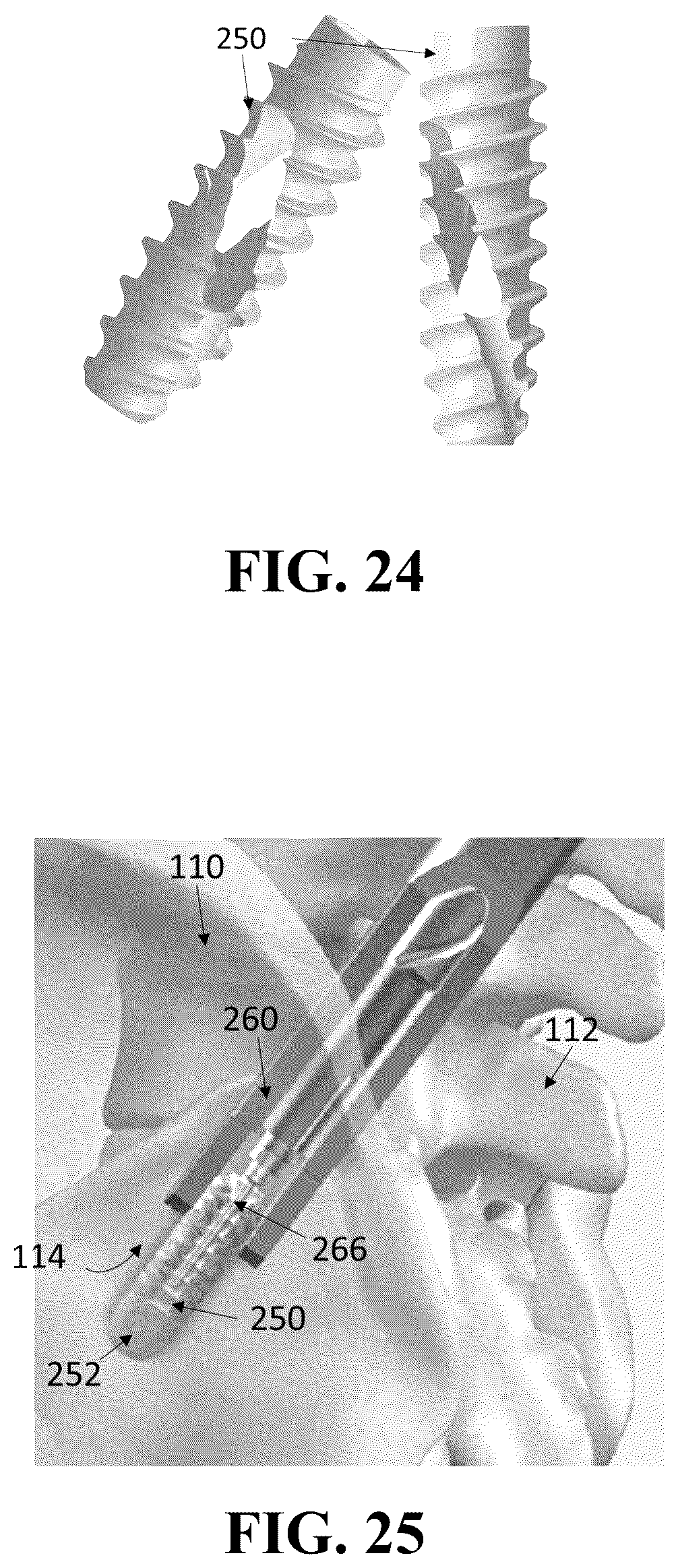 Patent US12426926 Figure 14 – Hybrid approach methods for sacroiliac joint stabilization