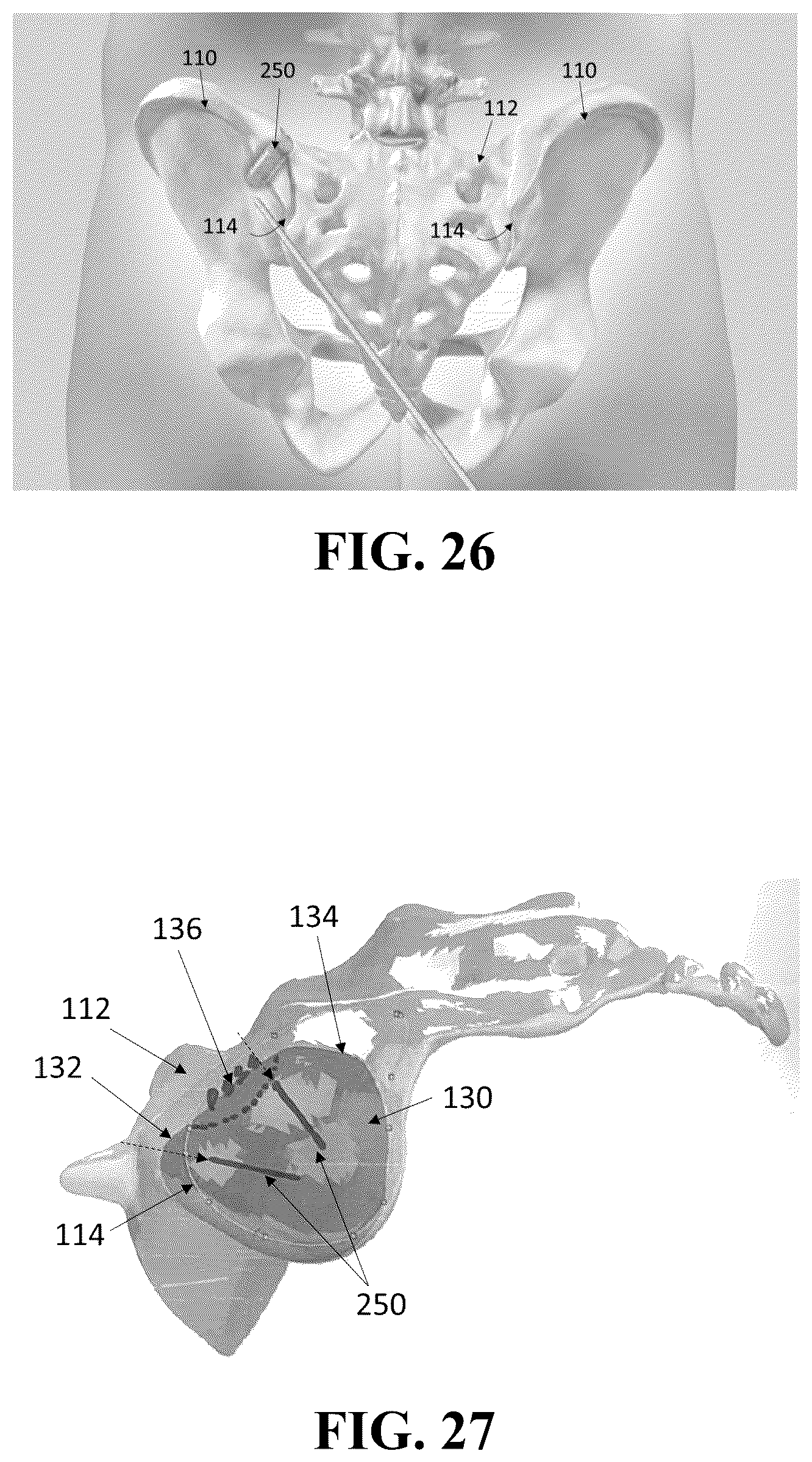 Patent US12426926 Figure 15 – Hybrid approach methods for sacroiliac joint stabilization