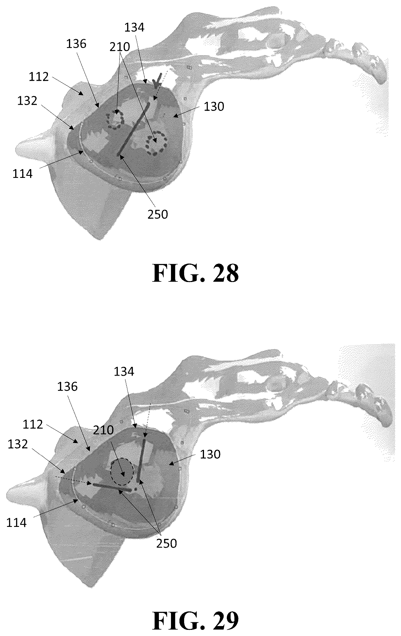 Patent US12426926 Figure 16 – Hybrid approach methods for sacroiliac joint stabilization