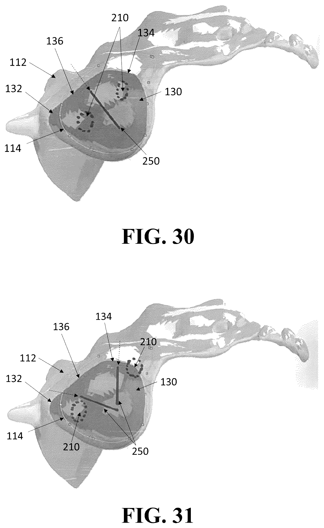 Patent US12426926 Figure 17 – Hybrid approach methods for sacroiliac joint stabilization
