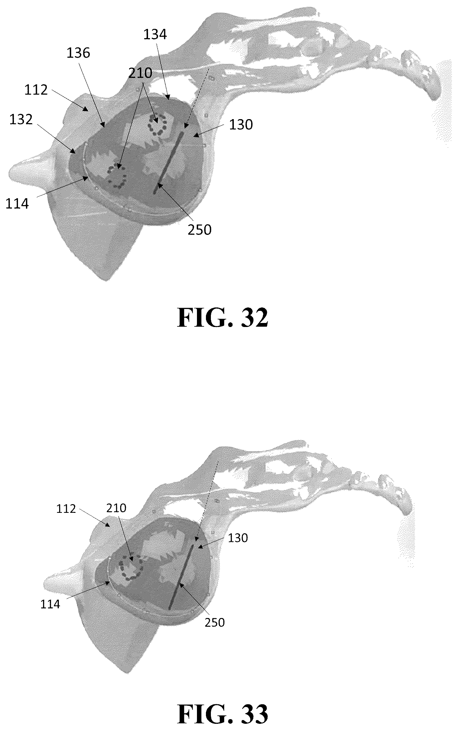 Patent US12426926 Figure 18 – Hybrid approach methods for sacroiliac joint stabilization