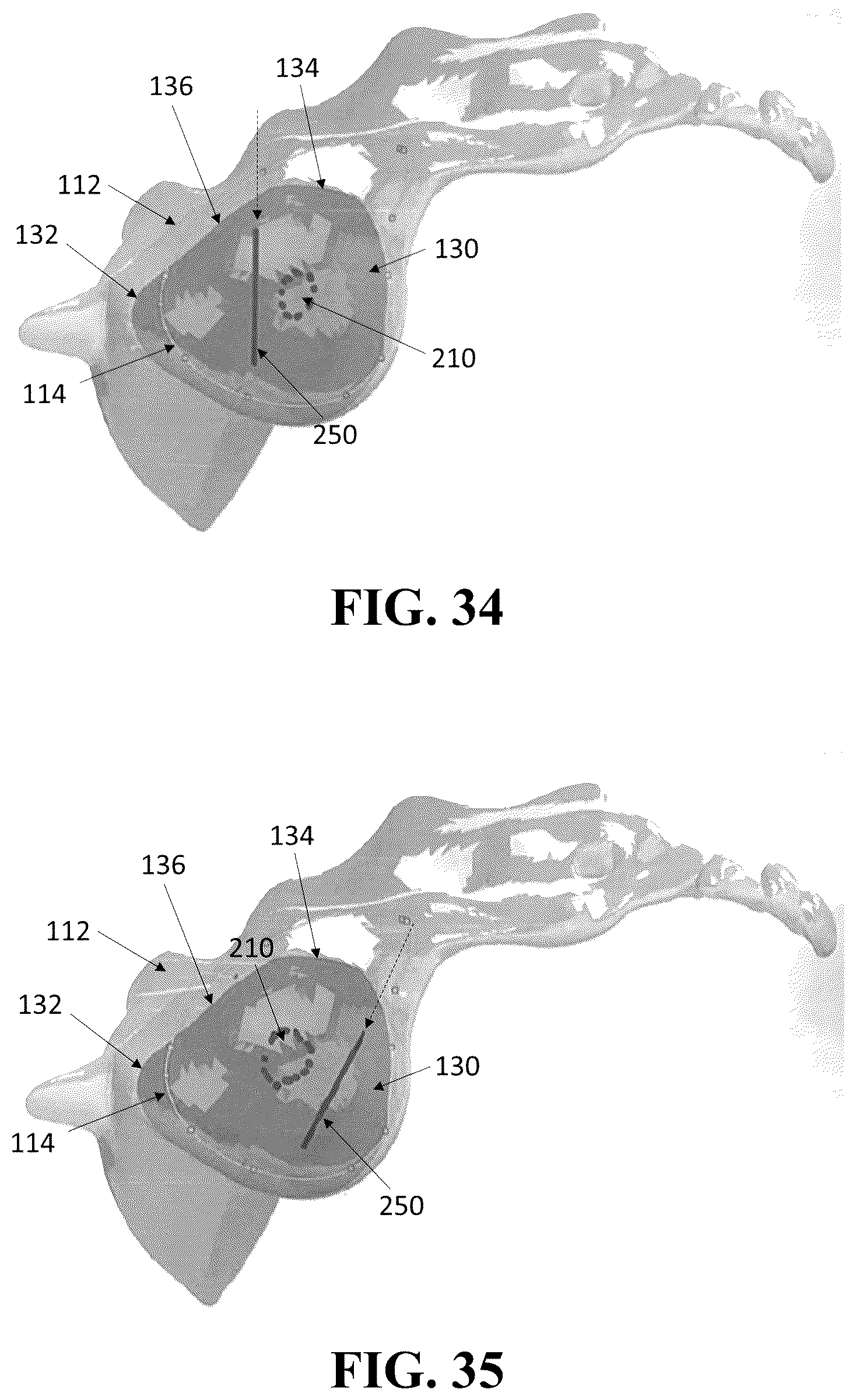 Patent US12426926 Figure 19 – Hybrid approach methods for sacroiliac joint stabilization