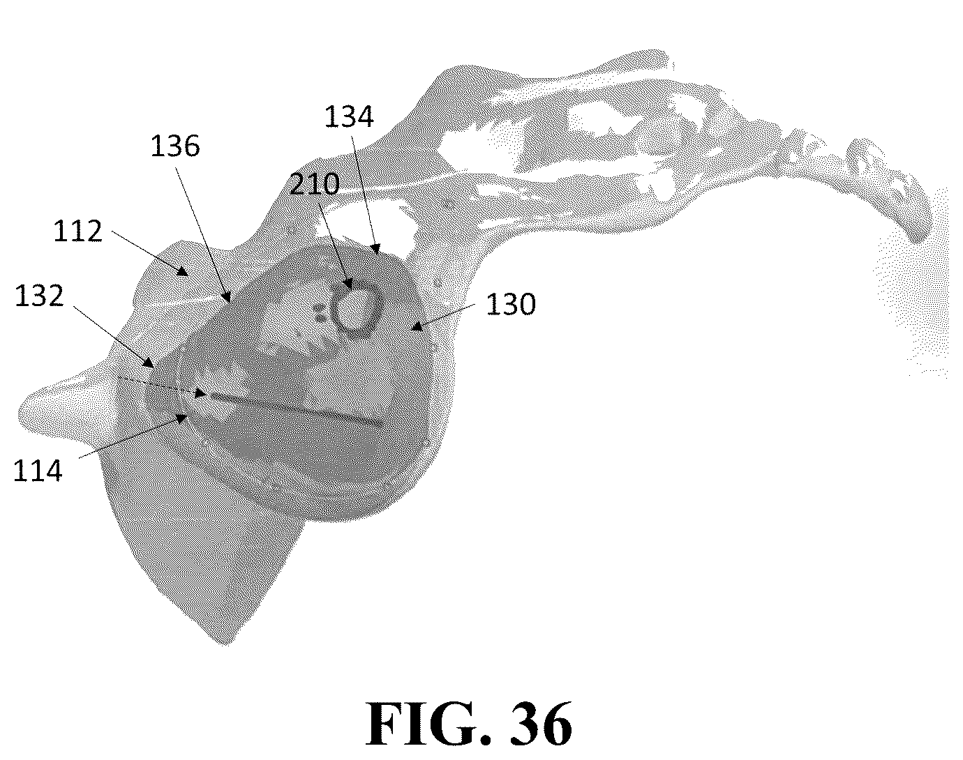 Patent US12426926 Figure 20 – Hybrid approach methods for sacroiliac joint stabilization