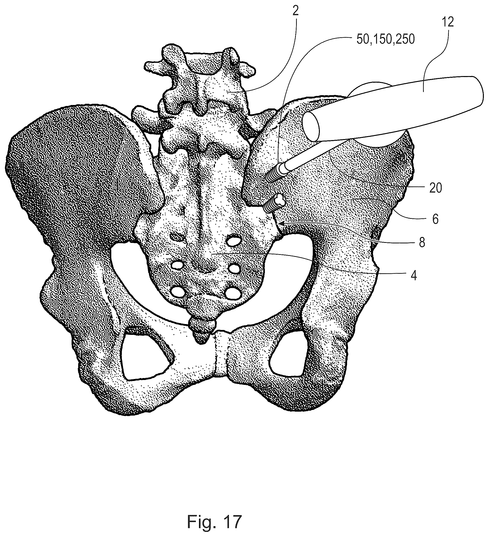 Patent US12426930 Figure 15 – Fusion device