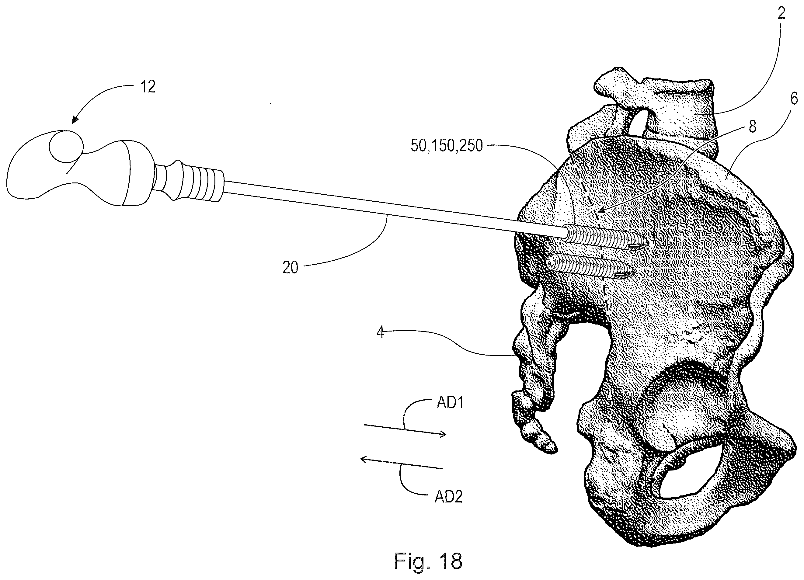 Patent US12426930 Figure 16 – Fusion device
