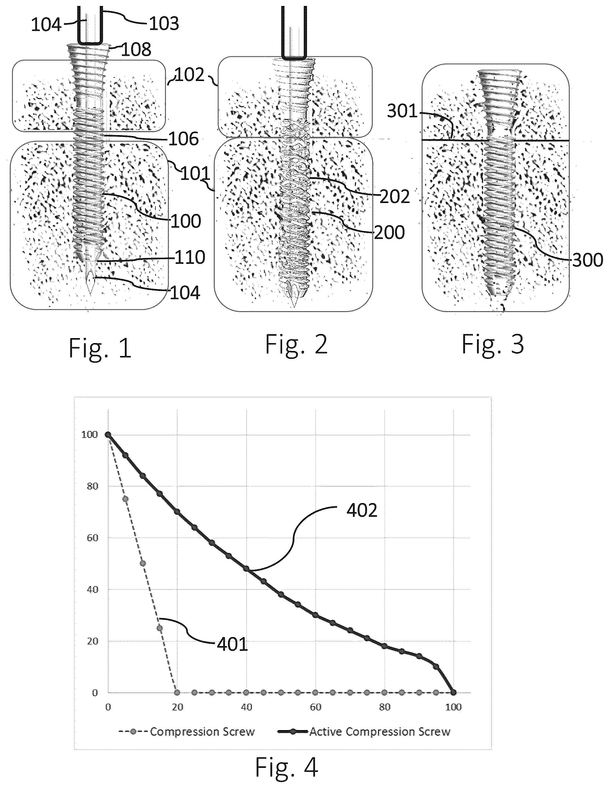 Patent US12426931 Figure 1 – Active compression apparatus, methods of assembly and methods of use