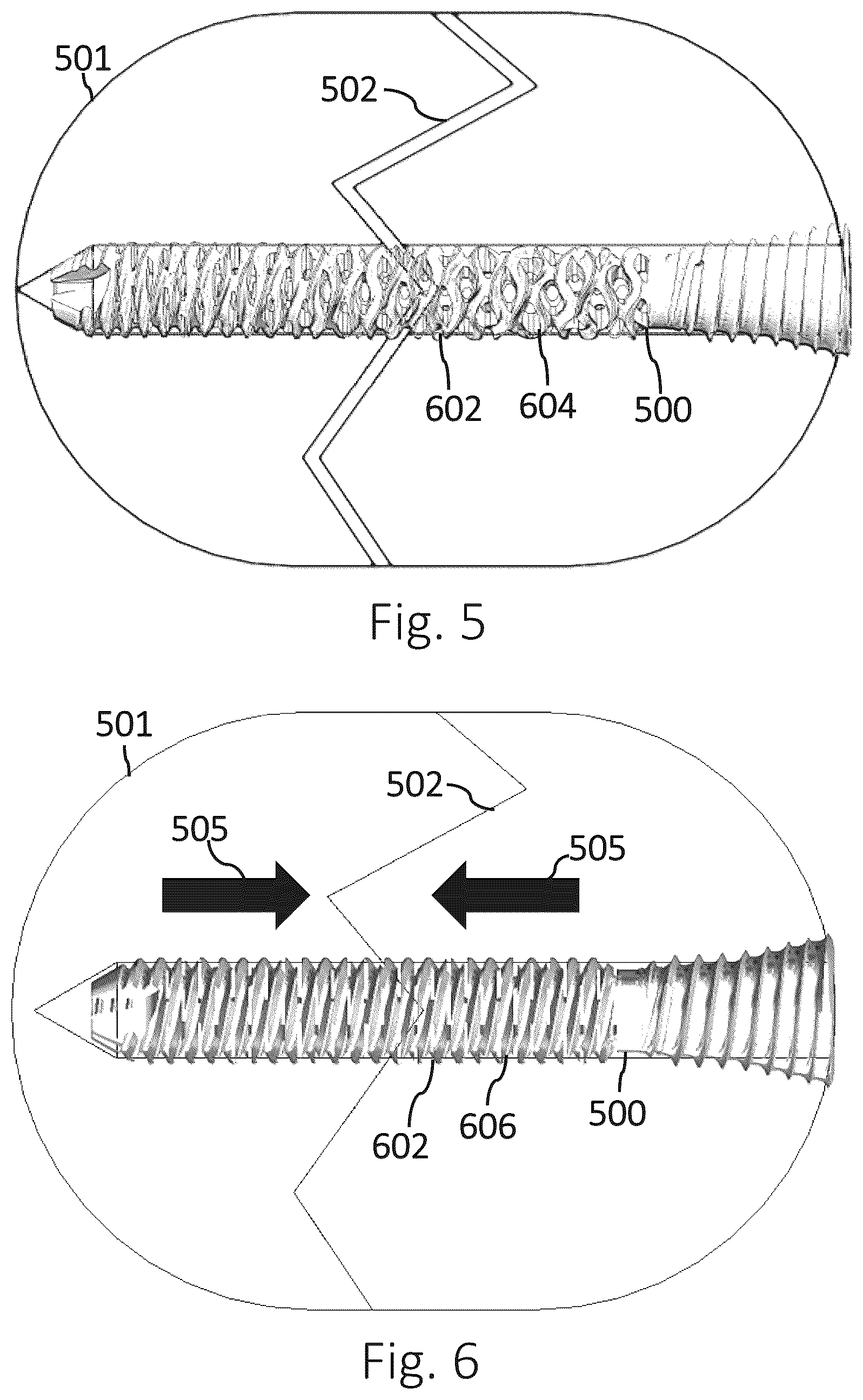 Patent US12426931 Figure 2 – Active compression apparatus, methods of assembly and methods of use