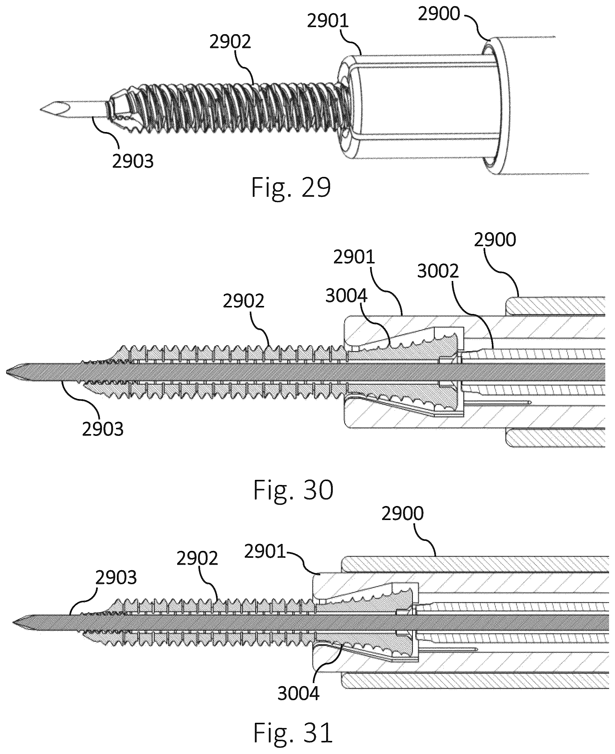 Patent US12426931 Figure 9 – Active compression apparatus, methods of assembly and methods of use