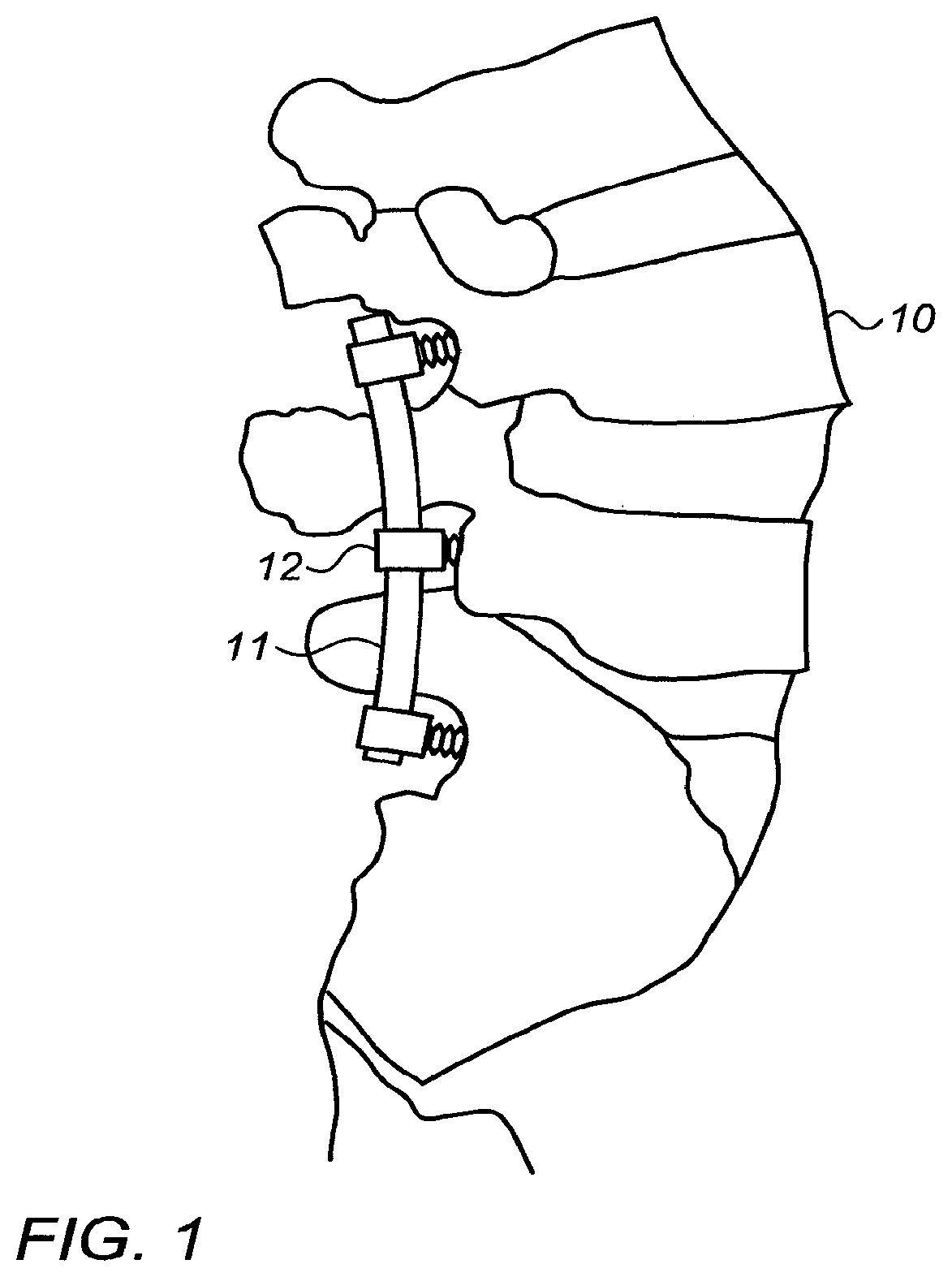 Patent US12426932 Figure 1 – Shaper for vertebral fixation rods