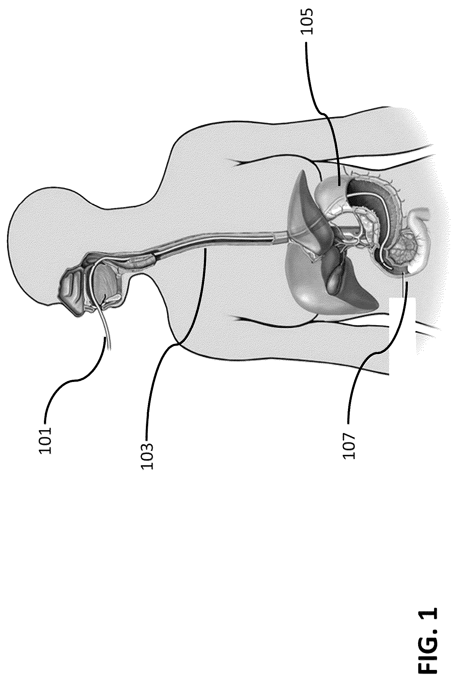 Patent US12426933 — Apparatus, systems and methods for soft tissue ablation — Figure 1