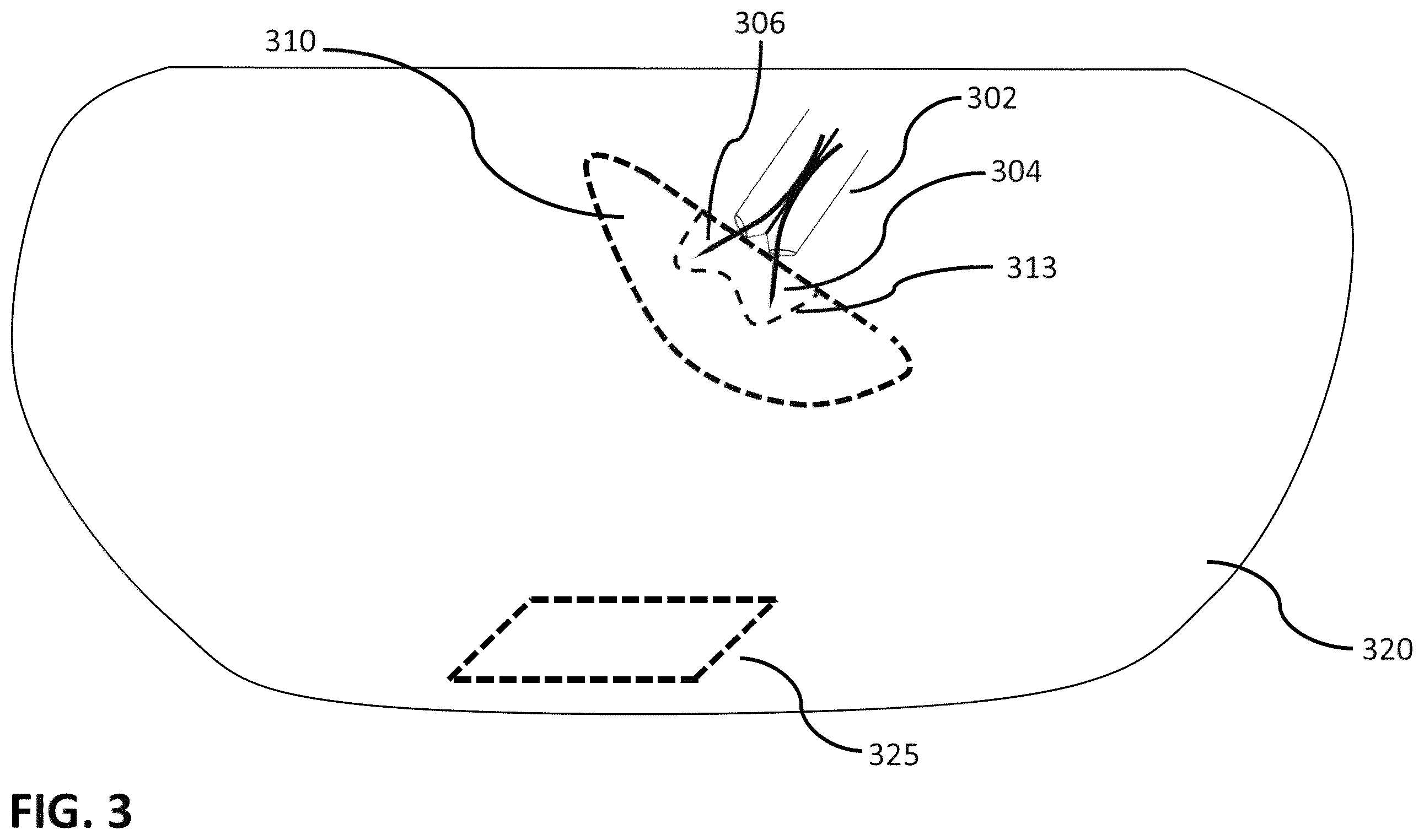 Patent US12426933 Figure 3 – Apparatus, systems and methods for soft tissue ablation