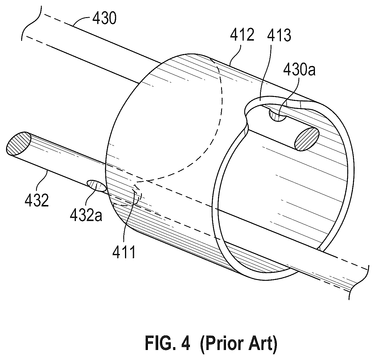 Patent US12426938 Figure 12 – Low profile electrodes for a shock wave catheter