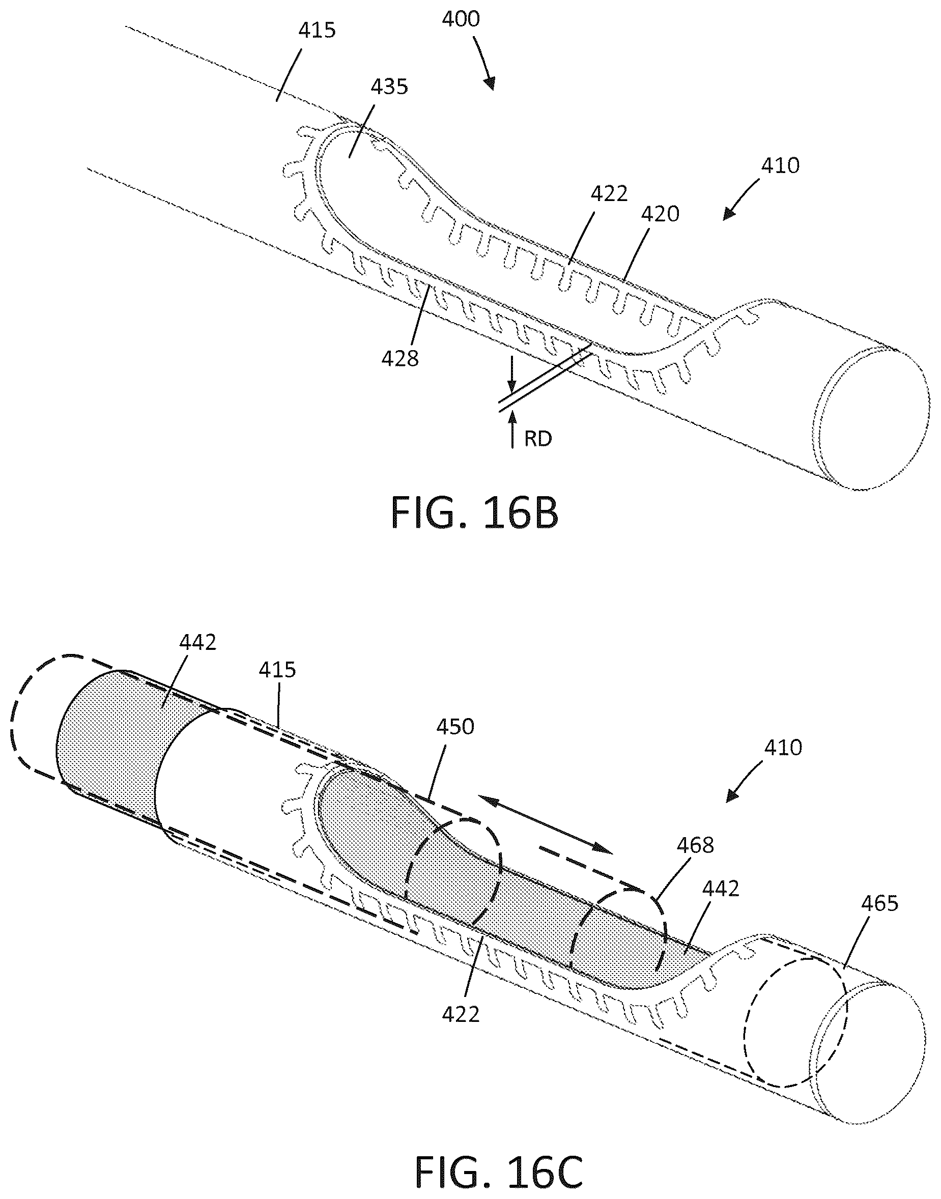 Patent US12426943 Figure 18 – Tissue extraction devices and methods
