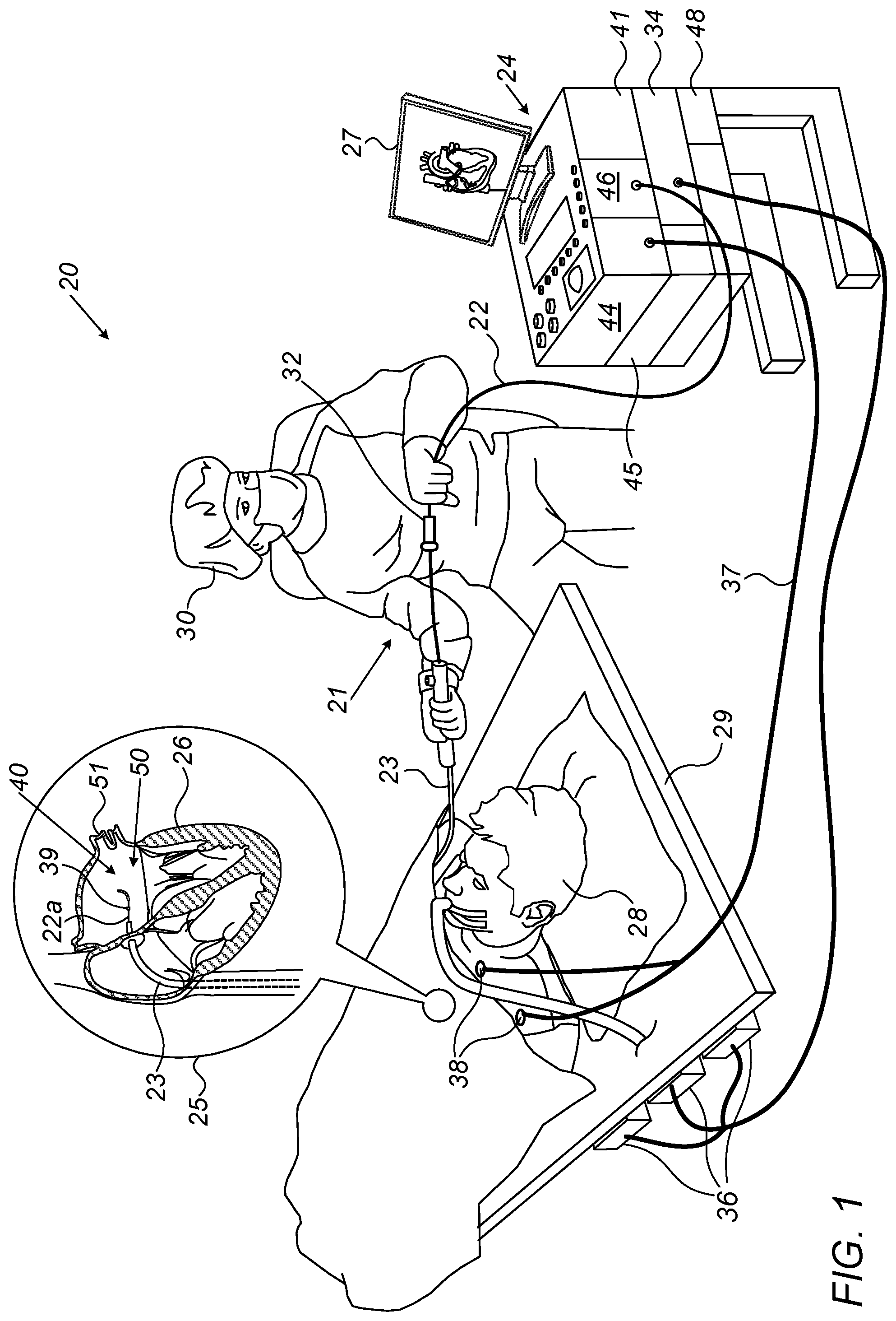 Patent US12426944 Figure 1 – Automatically performing irreversible electroporation ablation during heart refractory period