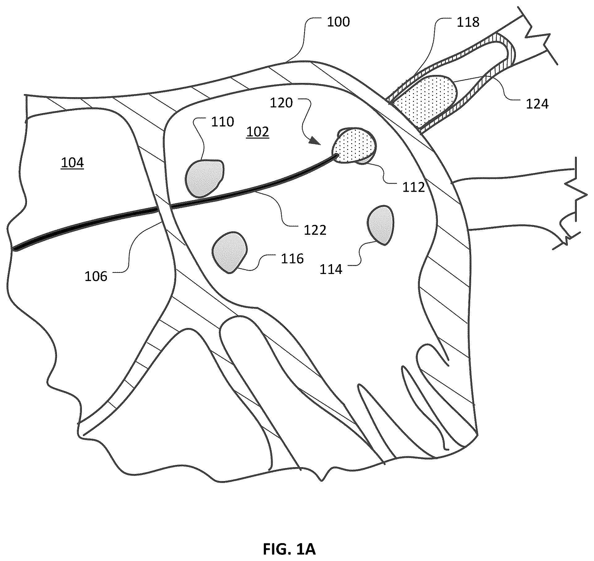 Patent US12426947 Figure 1 – Devices and methods for ablation of tissue