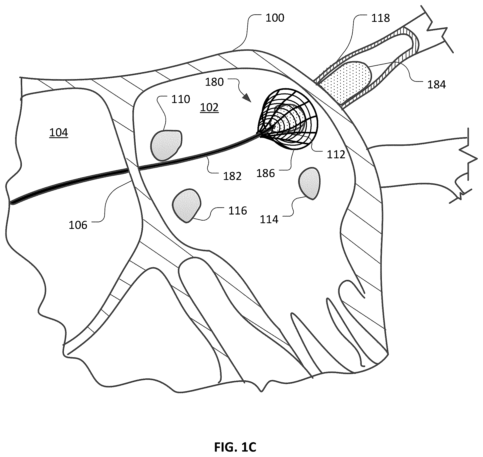 Patent US12426947 Figure 3 – Devices and methods for ablation of tissue